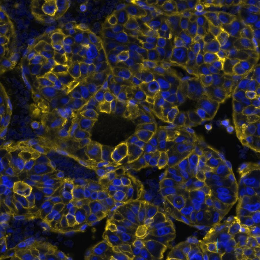 HLA ABC Antibody (MHC-I/8366R) - Azide and BSA Free HLA ABC Antibody (MHC-I/8366R) Detection of HLA-ABC/MHC I in Human Liver Tumor via seqIF� staining on COMET�