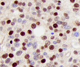 p27/Kip1 antibody in Human Prostate Cancer Tissue by Immunohistochemistry (IHC-P).