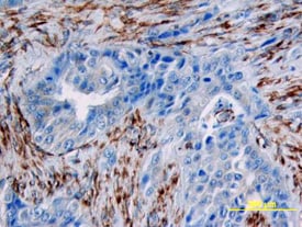 p53 antibody in Human Breast by Immunohistochemistry (IHC-P).
