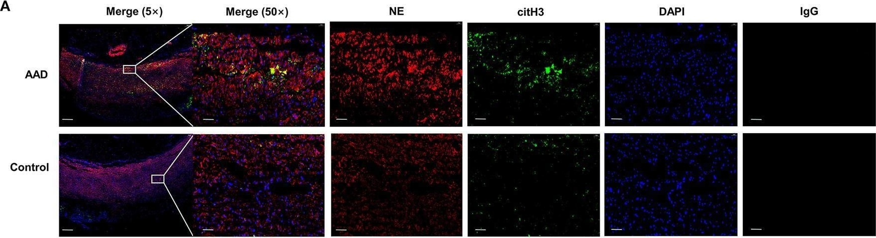 Detection of Neutrophil Elastase/ELA2 by Immunohistochemistry