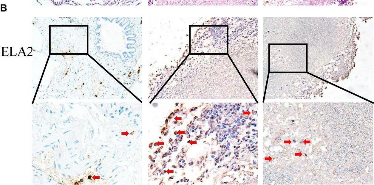 Detection of Neutrophil Elastase/ELA2 by Immunohistochemistry