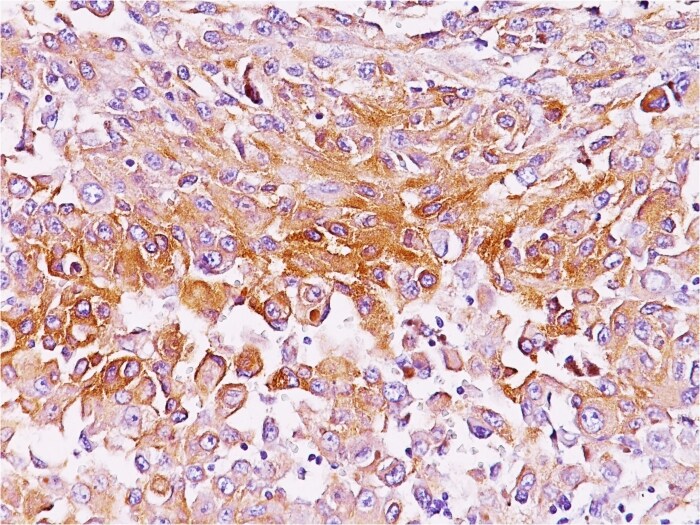 PMEL17/SILV Antibody (NKI-beteb) - Azide and BSA Free Immunohistochemistry-Paraffin: PMEL17/SILV Antibody (NKI-beteb) - Azide and BSA Free [NBP2-33172] -