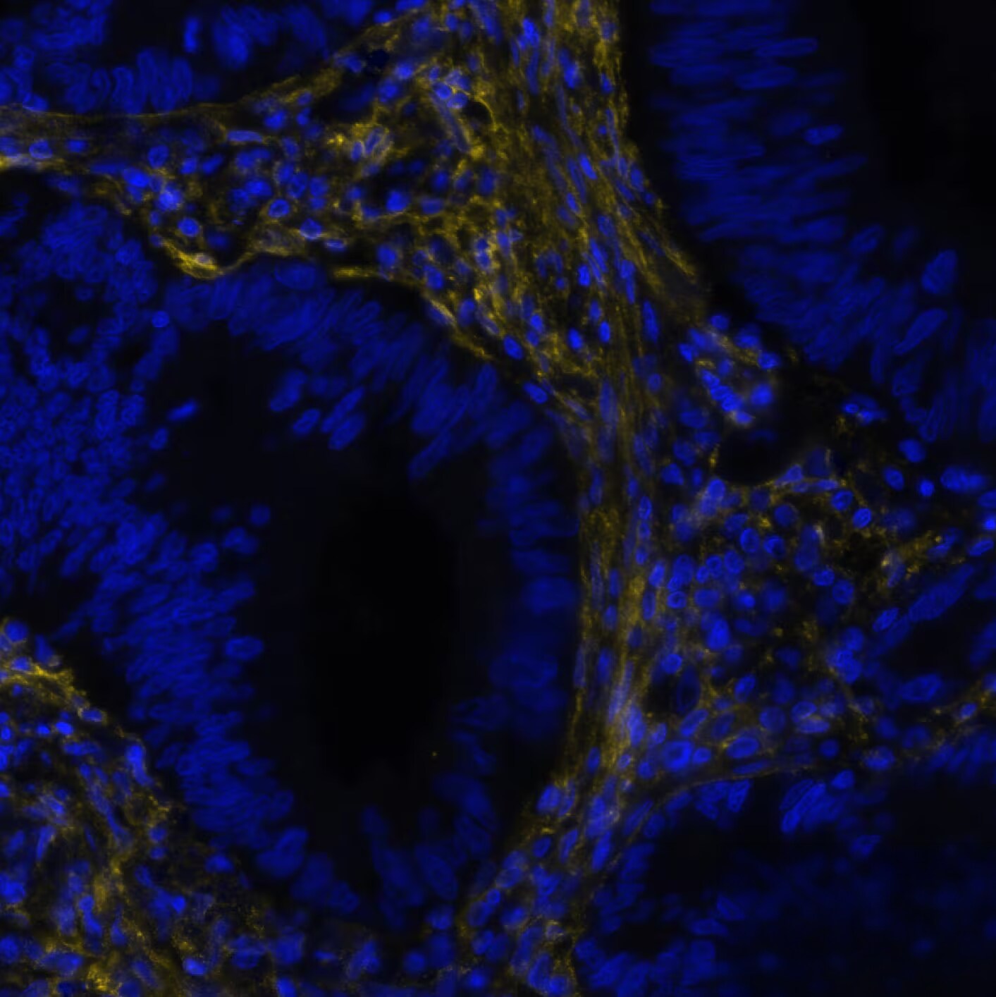 Fibroblast Activation Protein alpha/FAP Antibody (BLR150J) Detection of FAP in Human Colon Cancer via seqIF™ staining on COMET™