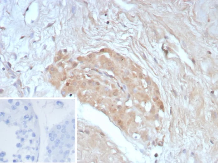 Survivin Antibody (BIRC5/8936R) Immunohistochemistry-Paraffin: Survivin Antibody (BIRC5/8936R) [NBP3-23790] -