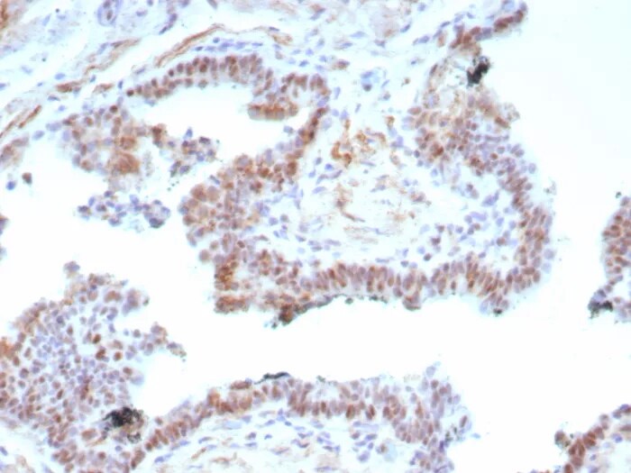 Androgen Receptor V7 Antibody (DHTR.V7/9125R) Immunohistochemistry-Paraffin: Androgen Receptor V7 Antibody (DHTR.V7/9125R) [NBP3-23818] -
