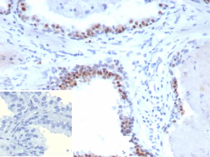 Androgen Receptor V7 Antibody (DHTR.V7/9394R) Immunohistochemistry-Paraffin: Androgen Receptor V7 Antibody (DHTR.V7/9394R) [NBP3-23821] -