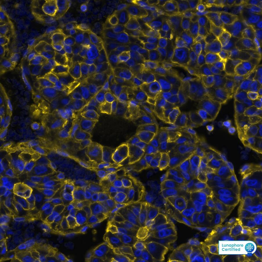 HLA ABC Antibody (MHC-I/8366R) - Azide and BSA Free HLA ABC Antibody (MHC-I/8366R) Detection of HLA-ABC/MHC I in Human Liver Tumor via seqIF� staining on COMET�
