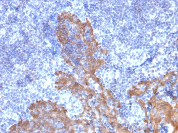 Cytokeratin 5/6 Antibody (KRT5.6/2090) Immunohistochemistry-Paraffin: Cytokeratin 5/6 Antibody (KRT5.6/2090) [NBP3-43590] -