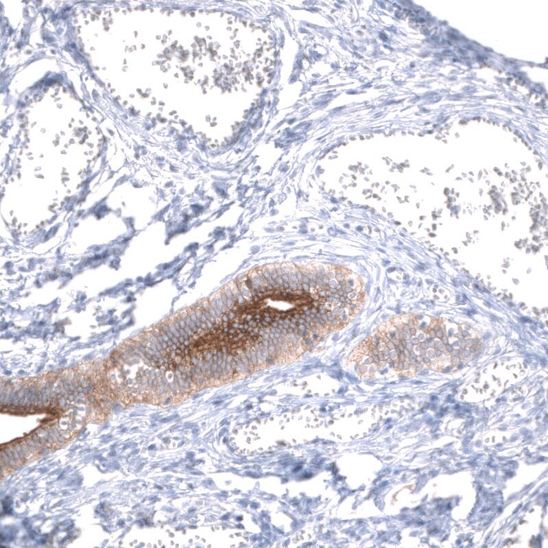 Mesothelin Antibody (CL13956) - Azide and BSA Free Immunohistochemistry-Paraffin: Mesothelin Antibody [NBP3-43845]