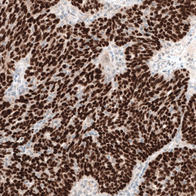 WT1 Antibody (CL13170) - Azide and BSA Free Immunohistochemistry-Paraffin: WT1 Antibody [NBP3-44378]