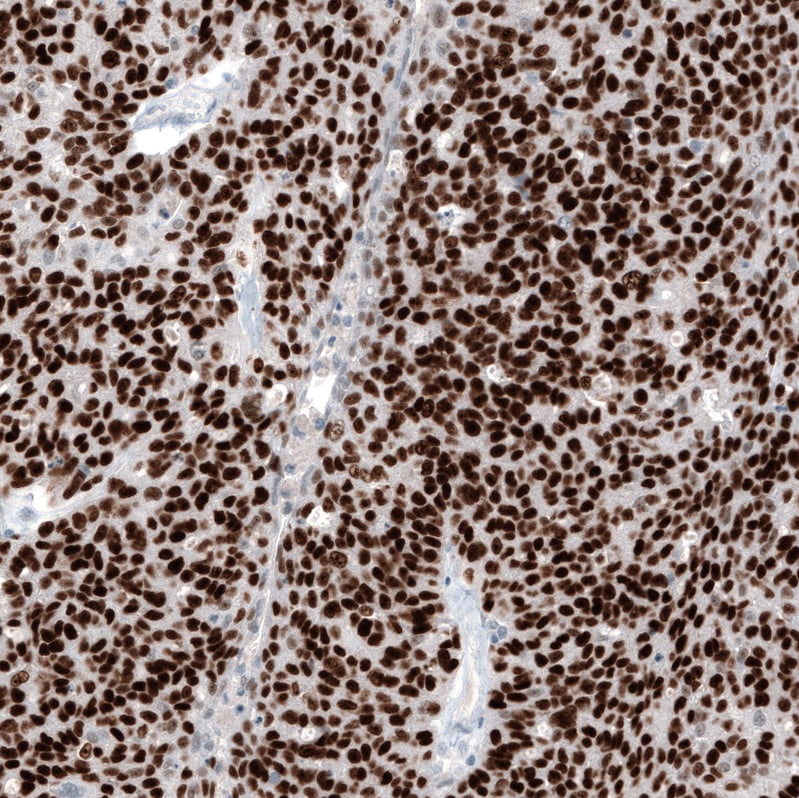 WT1 Antibody (CL13170) - Azide and BSA Free Immunohistochemistry-Paraffin: WT1 Antibody [NBP3-44378]