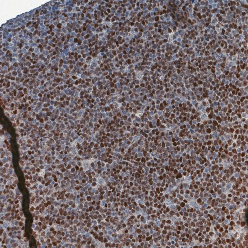 SOX11 Antibody (CL0142) Immunohistochemistry: SOX11 Antibody (CL0142) [NBP3-52441]