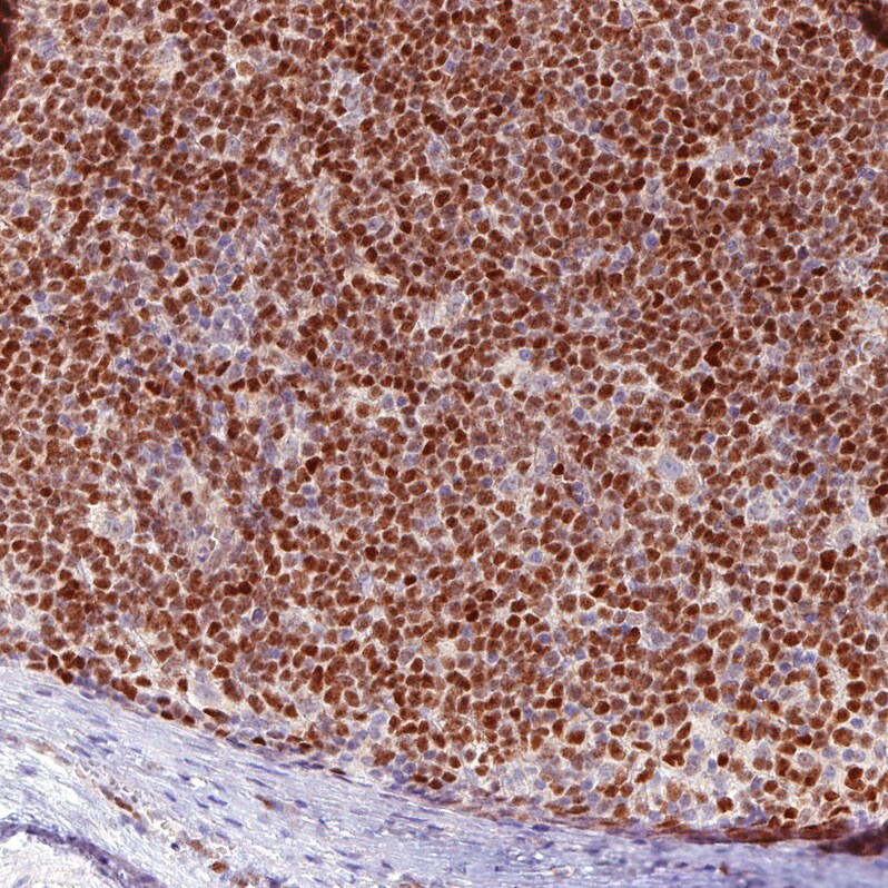 SOX11 Antibody (CL0143) Immunohistochemistry: SOX11 Antibody (CL0143) [NBP3-52442]