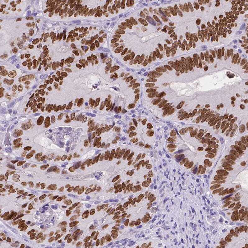 SATB2 Antibody (CL0320) Immunohistochemistry: SATB2 Antibody (CL0320) [NBP3-52448]