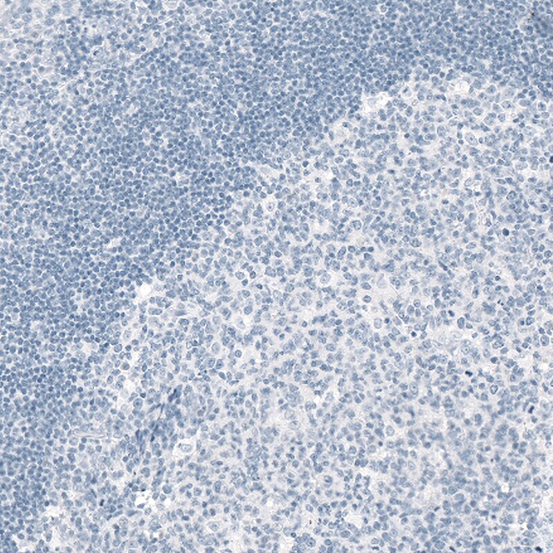 OTP Antibody (CL11225) Immunohistochemistry-Paraffin: SOX11 Antibody (CL0142) [NBP3-52441]