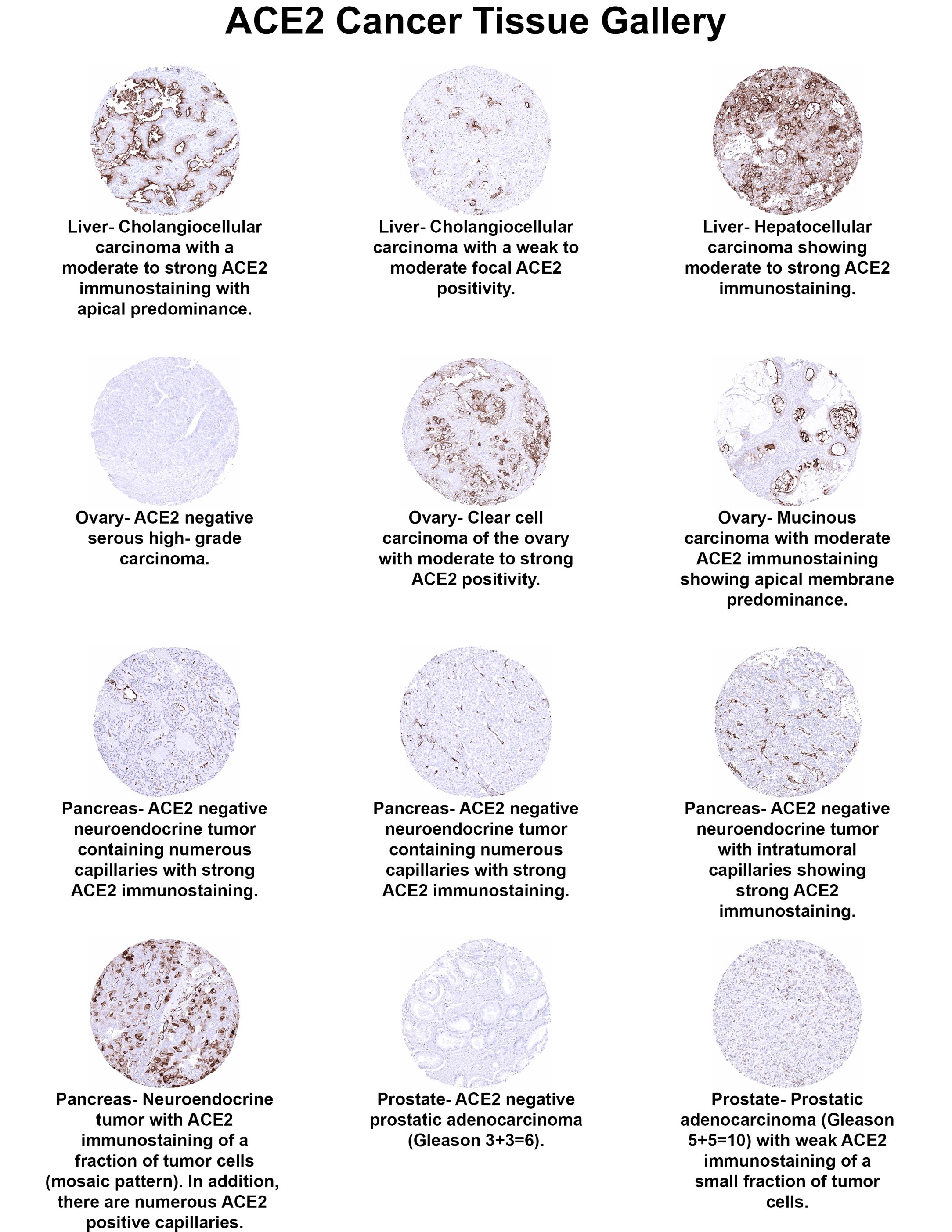 ACE-2 Antibody (MSVA-919R) ACE2 Cancer Tissue Gallery