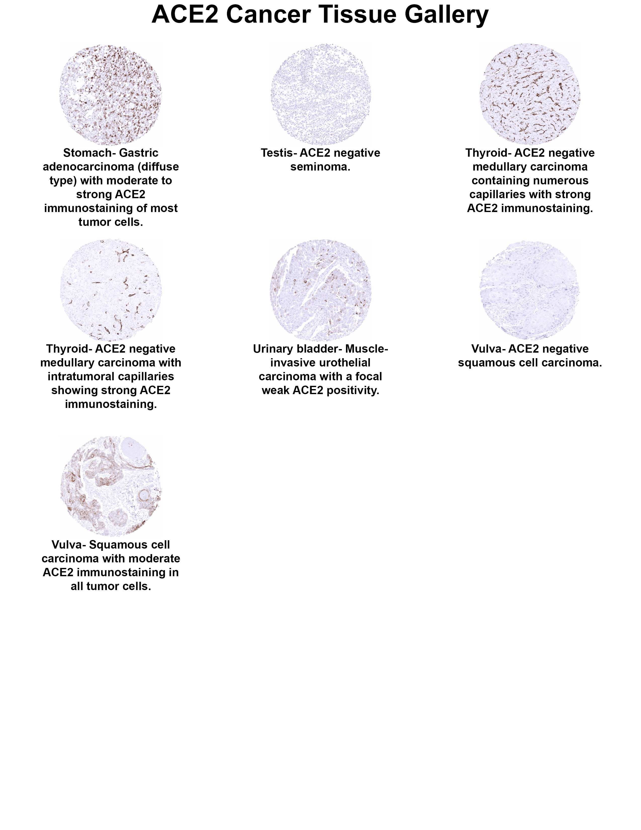 ACE-2 Antibody (MSVA-919R) ACE2 Cancer Tissue Gallery