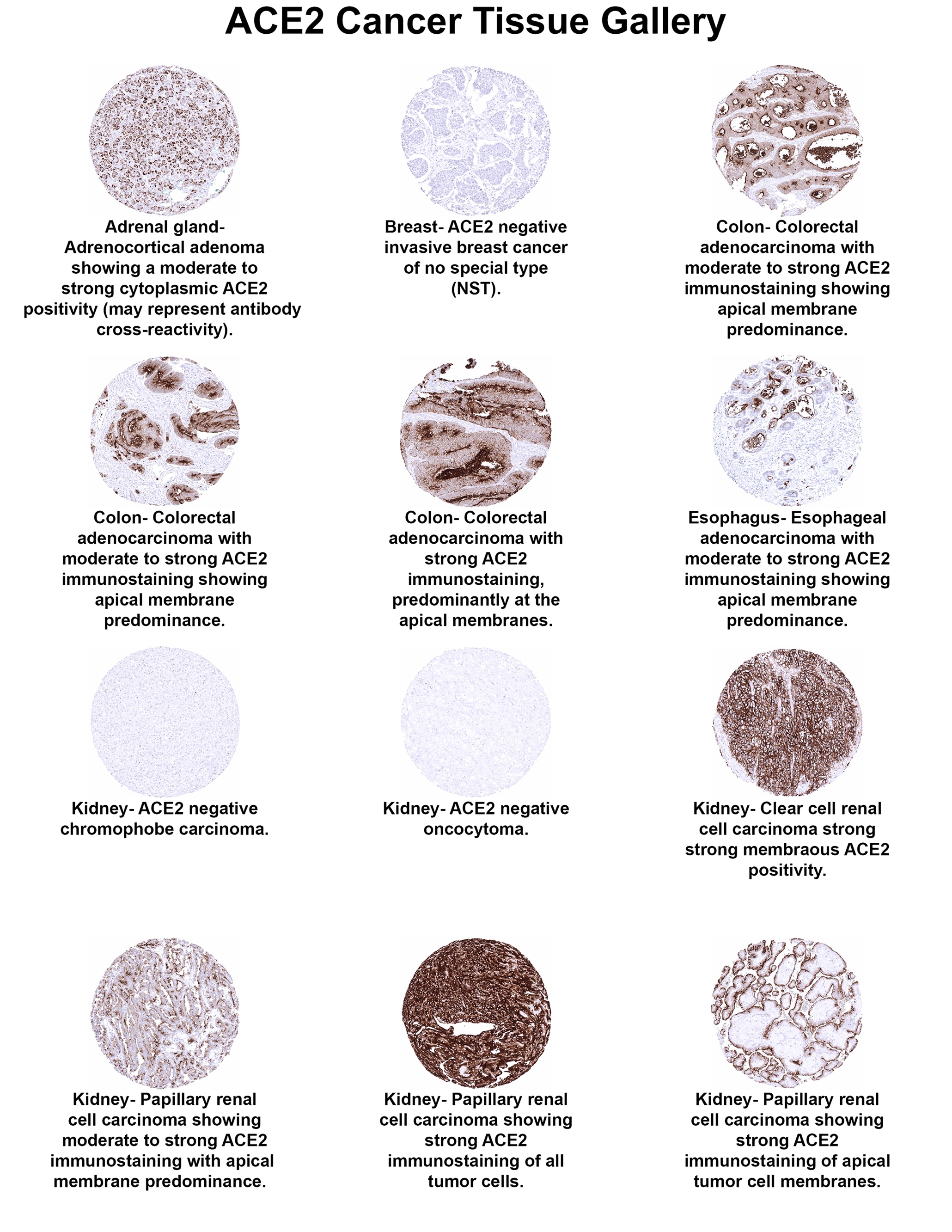 ACE-2 Antibody (MSVA-919R) - Azide and BSA Free ACE2 Cancer Tissue Gallery