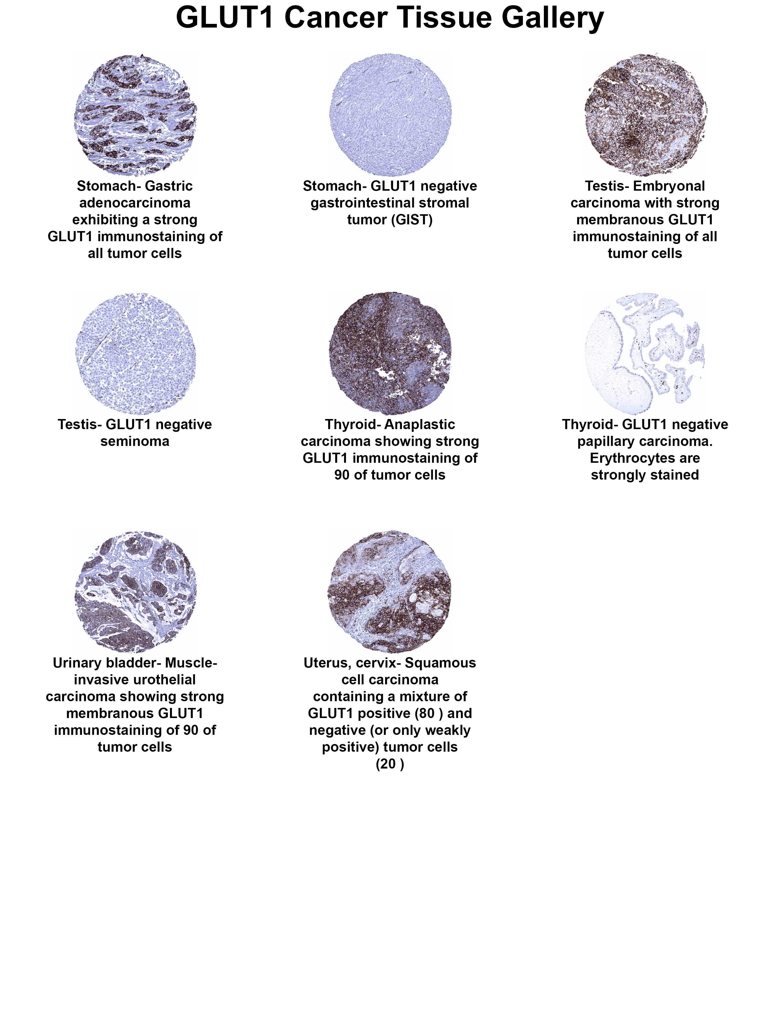 Glut1 Antibody (MSVA-401R) Glut1 Antibody (MSVA-401R) Glut1 Cancer Tissue Gallery