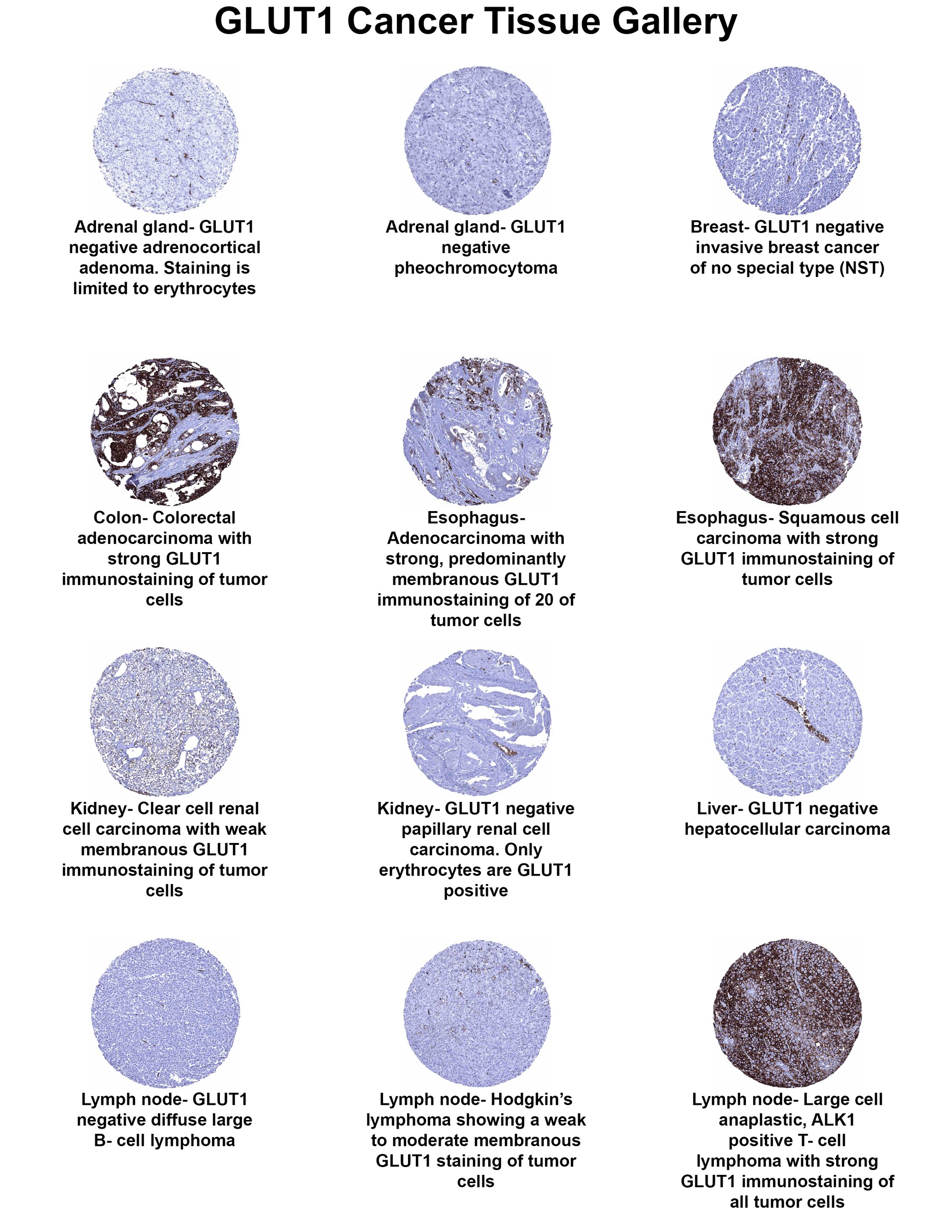 Glut1 Antibody (MSVA-401R) Glut1 Antibody (MSVA-401R) Glut1 Cancer Tissue Gallery
