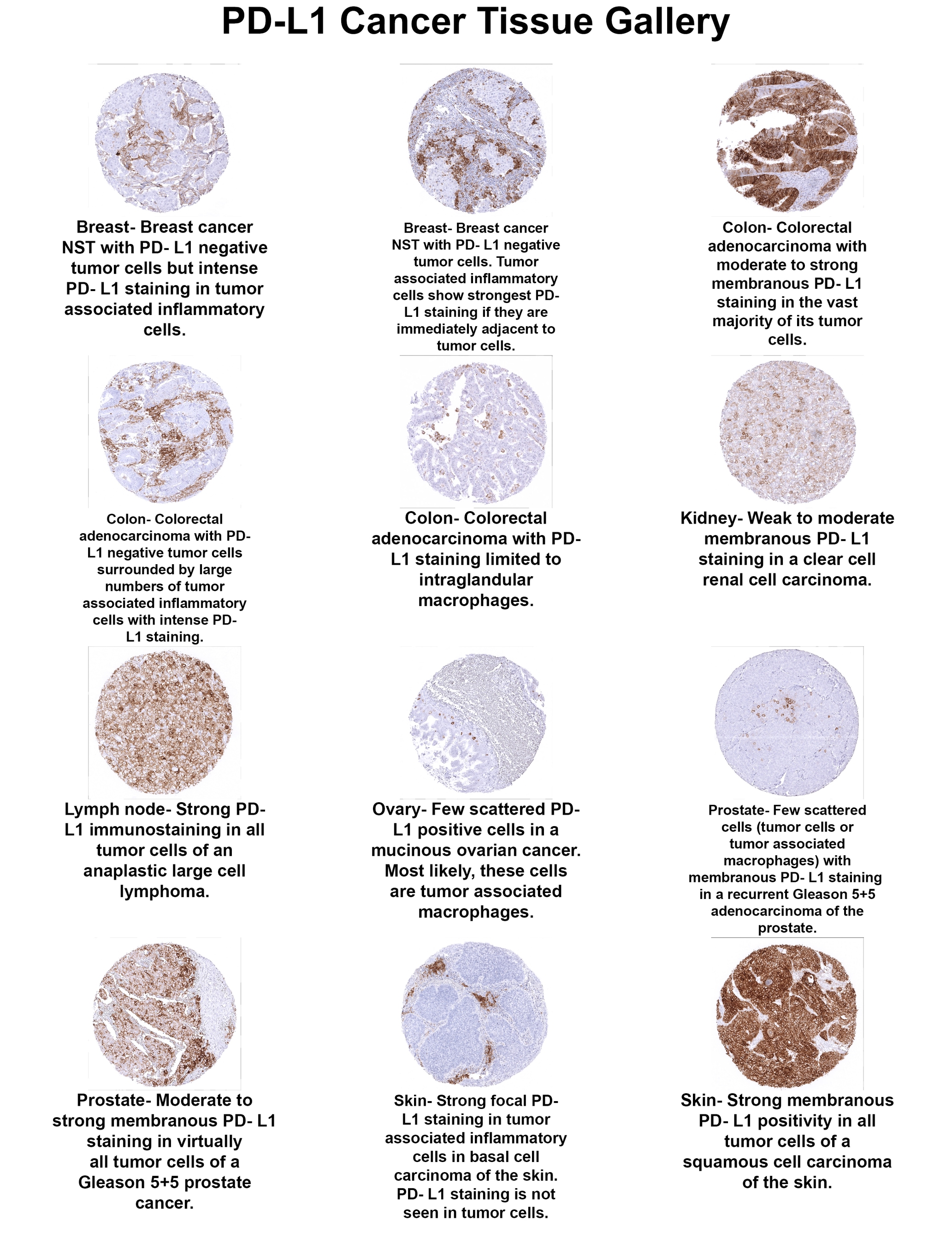 PD-L1 Antibody (MSVA-711R) PD-L1 Antibody (MSVA-711R) PD-L1 Cancer Tissue Gallery