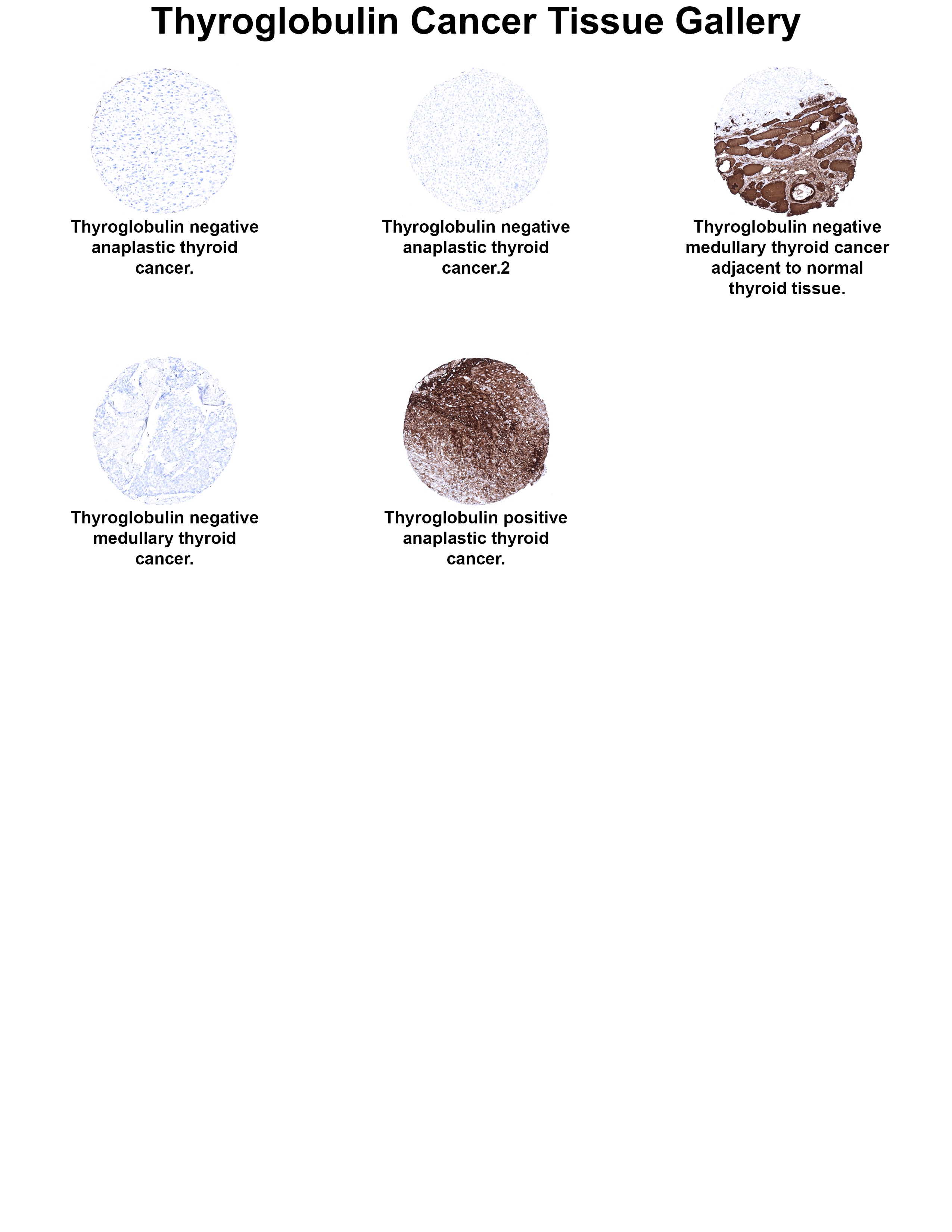 Thyroglobulin Antibody (MSVA-189R) Thyroglobulin Antibody (MSVA-189R) Thyroglobulin Cancer Tissue Gallery