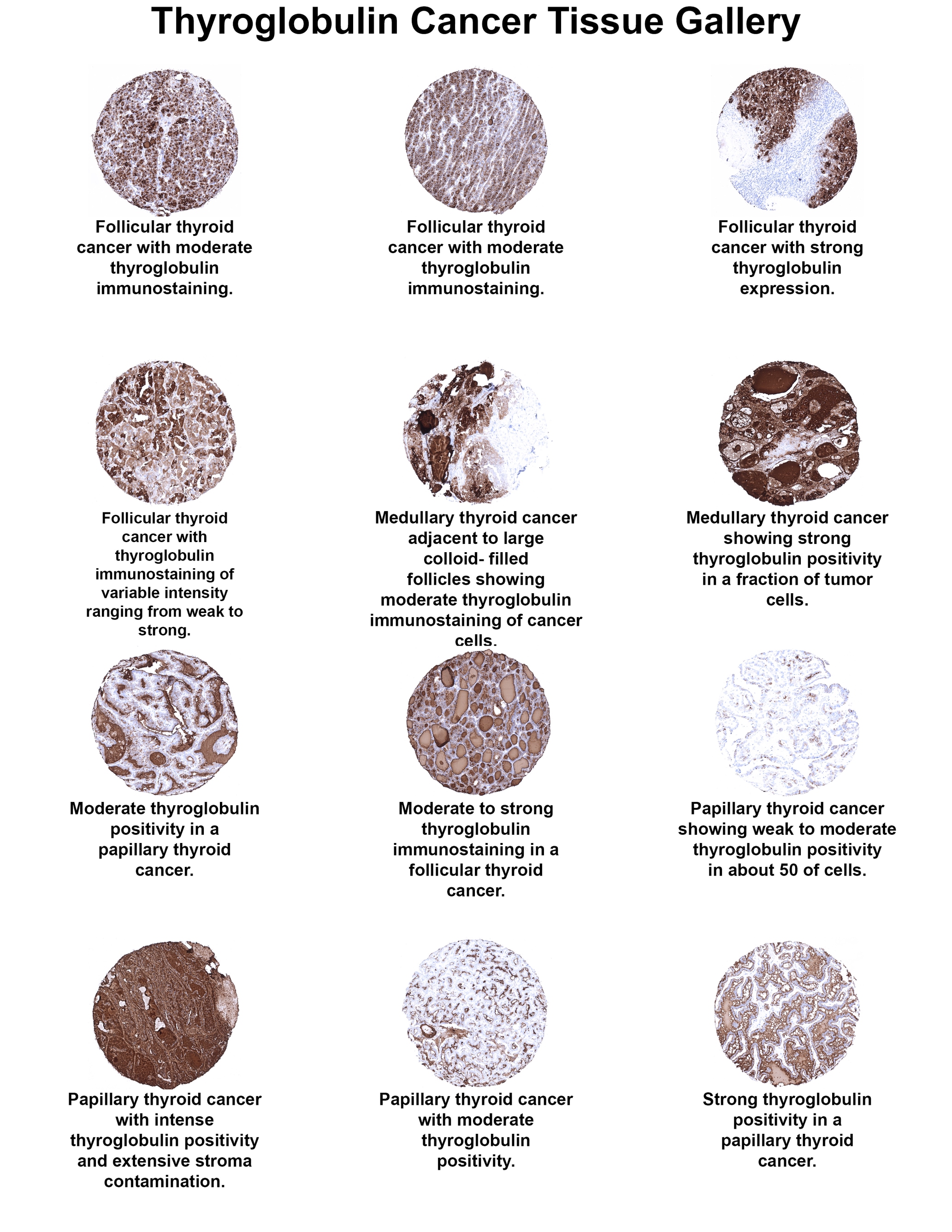 Thyroglobulin Antibody (MSVA-189R) Thyroglobulin Antibody (MSVA-189R) Thyroglobulin Cancer Tissue Gallery