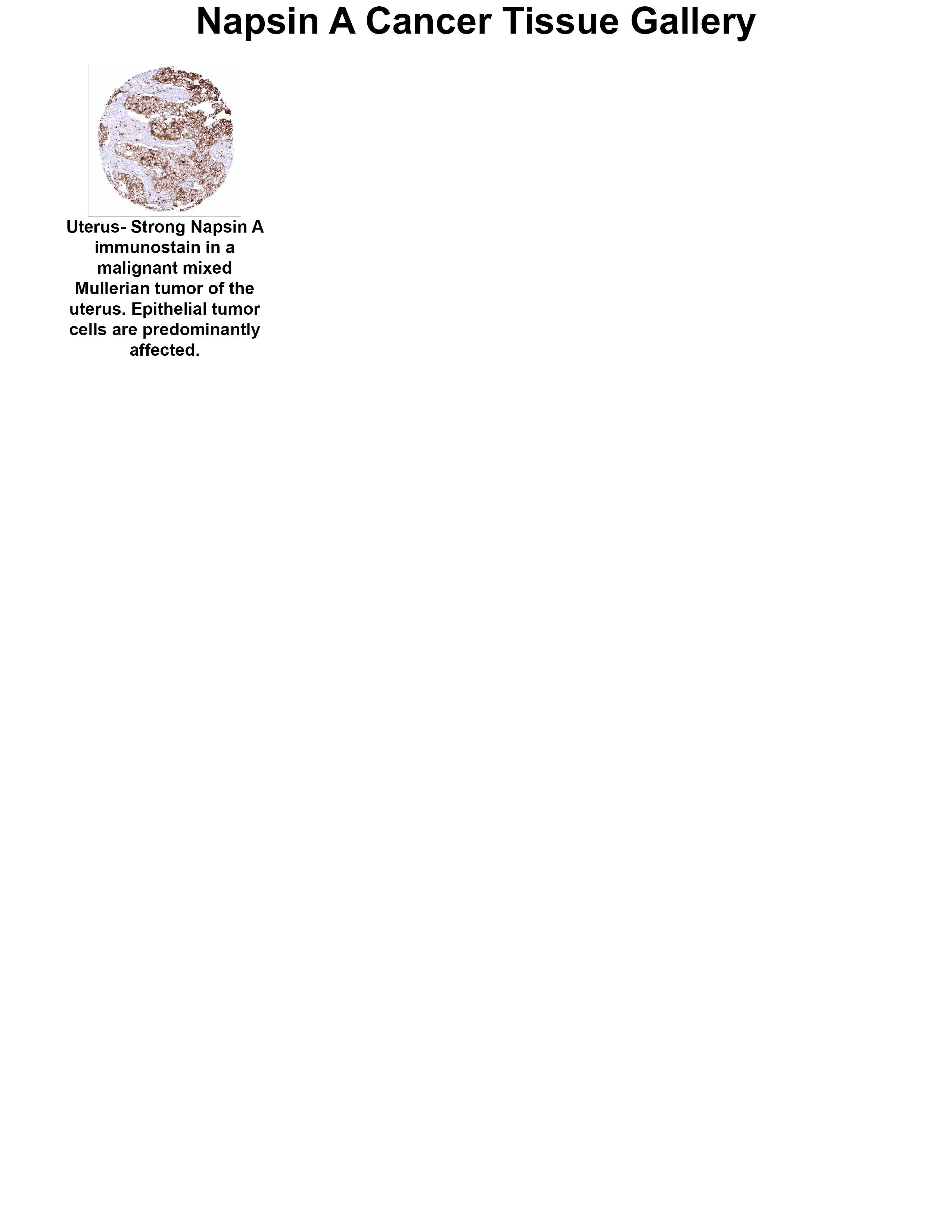 Napsin A Antibody (MSVA-112R) Napsin A Antibody (MSVA-112R) Napsin A Cancer Tissue Gallery