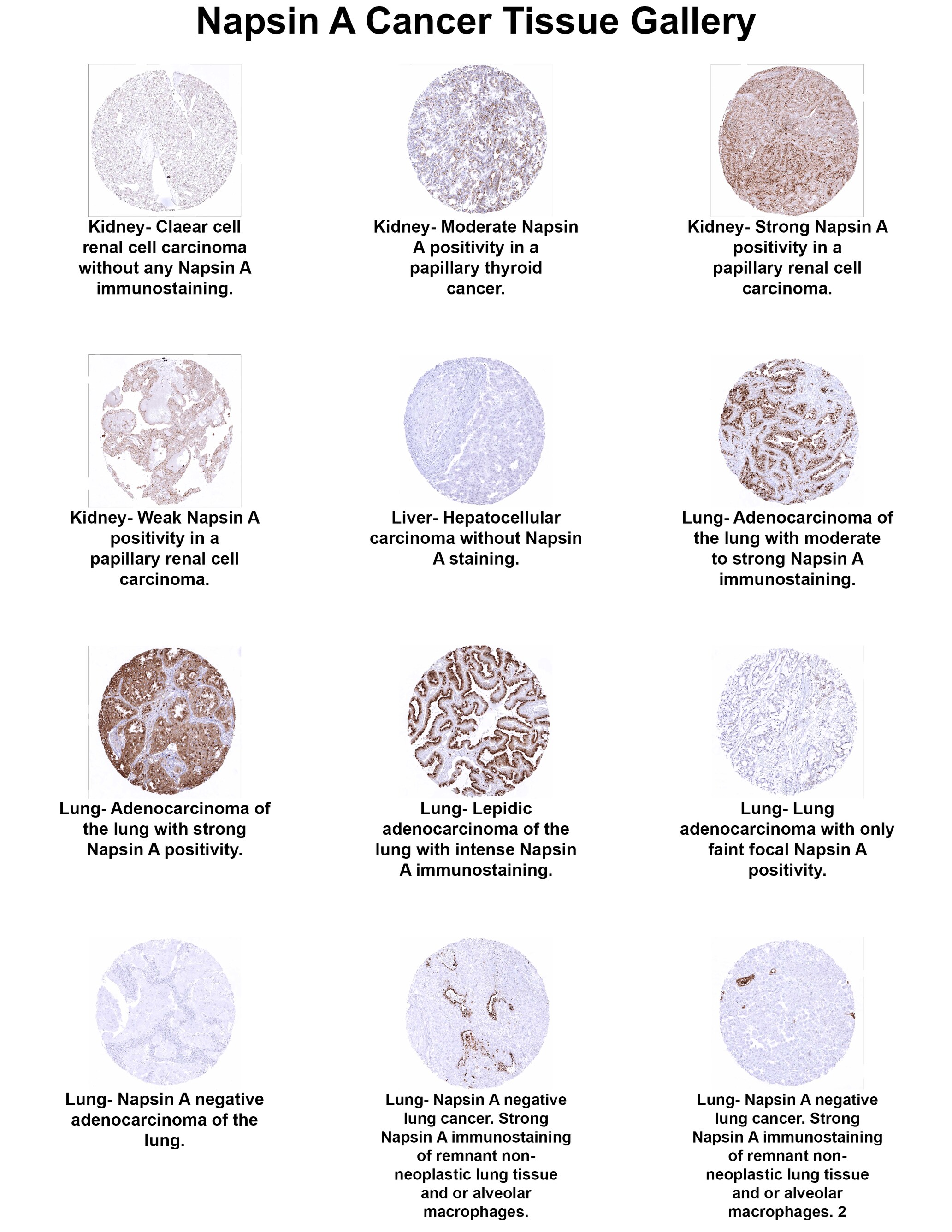 Napsin A Antibody (MSVA-112R) Napsin A Antibody (MSVA-112R) Napsin A Cancer Tissue Gallery