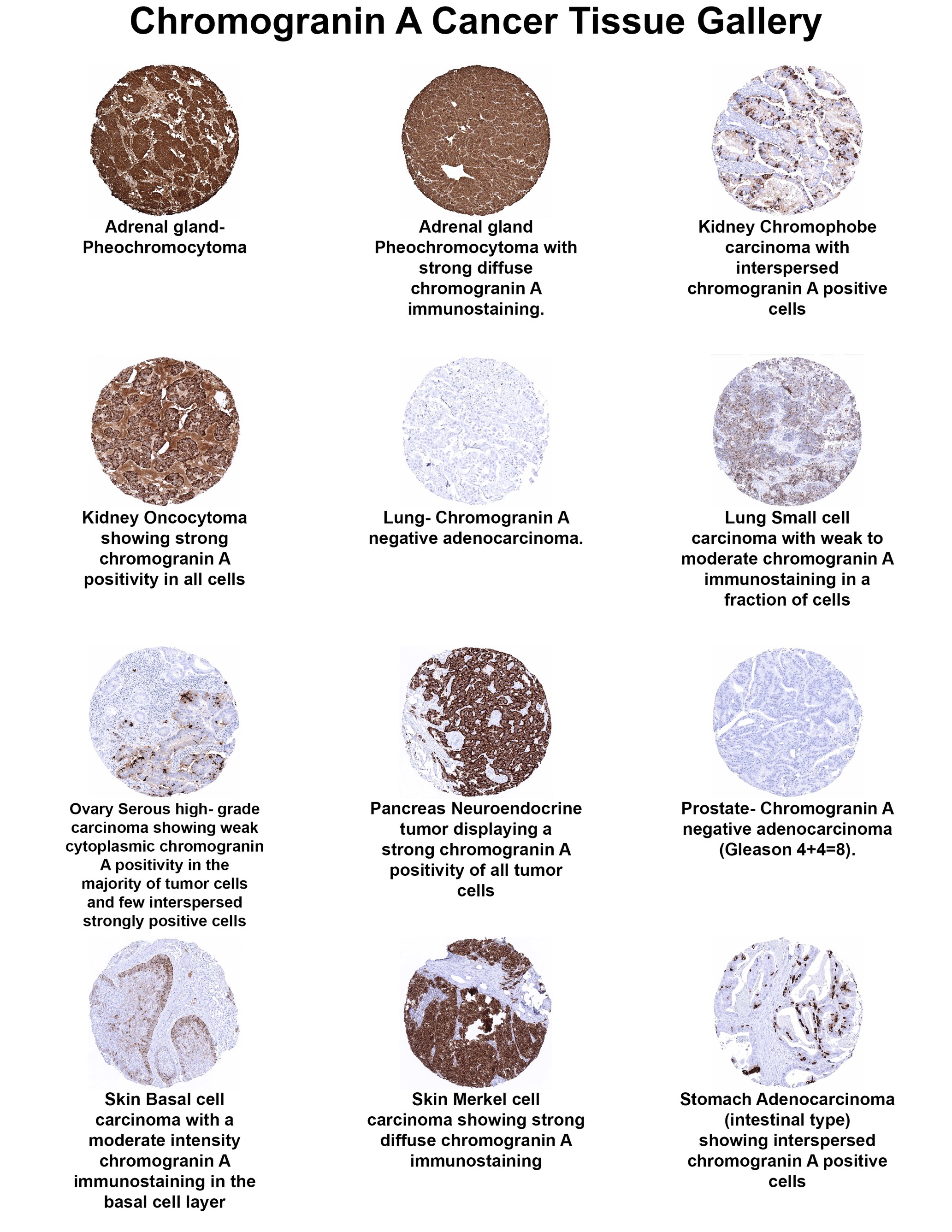 Chromogranin A Antibody (MSVA-380R) Chromogranin A Antibody (MSVA-380R) Chromogranin A Cancer Tissue Gallery