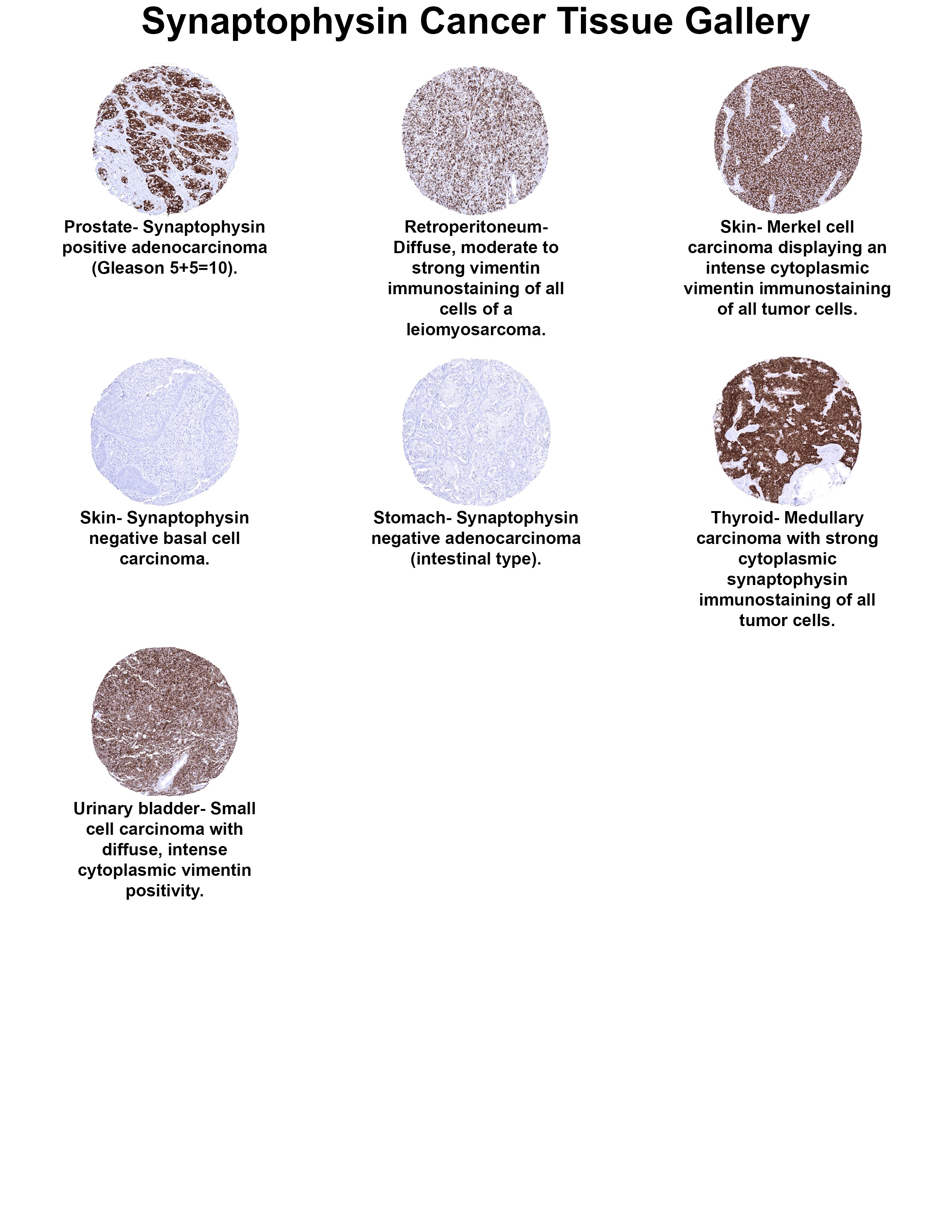 Synaptophysin Antibody (MSVA-462R) Synaptophysin Antibody (MSVA-462R) Synaptophysin Cancer Tissue Gallery