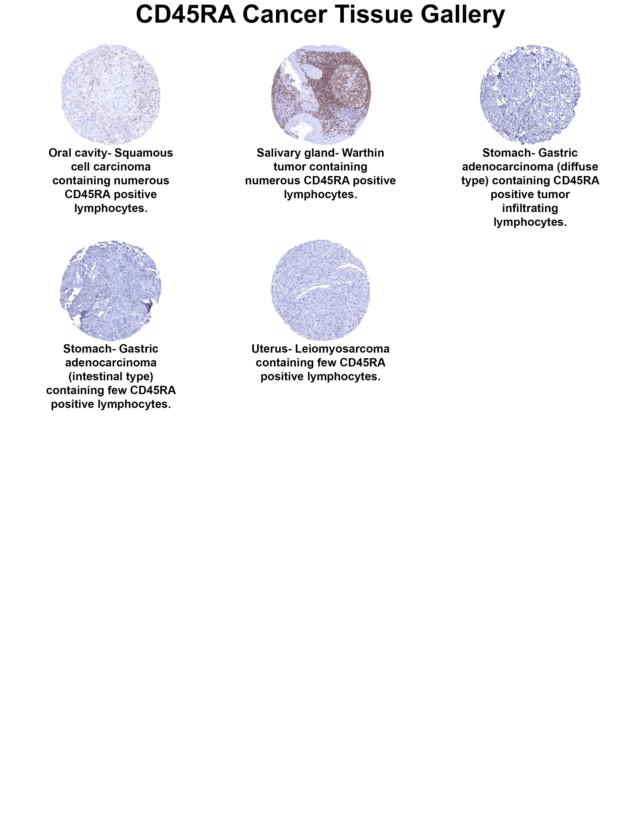 CD45RA Antibody (MSVA-472M) CD45RA Antibody (MSVA-472M) CD45RA Cancer Tissue Gallery