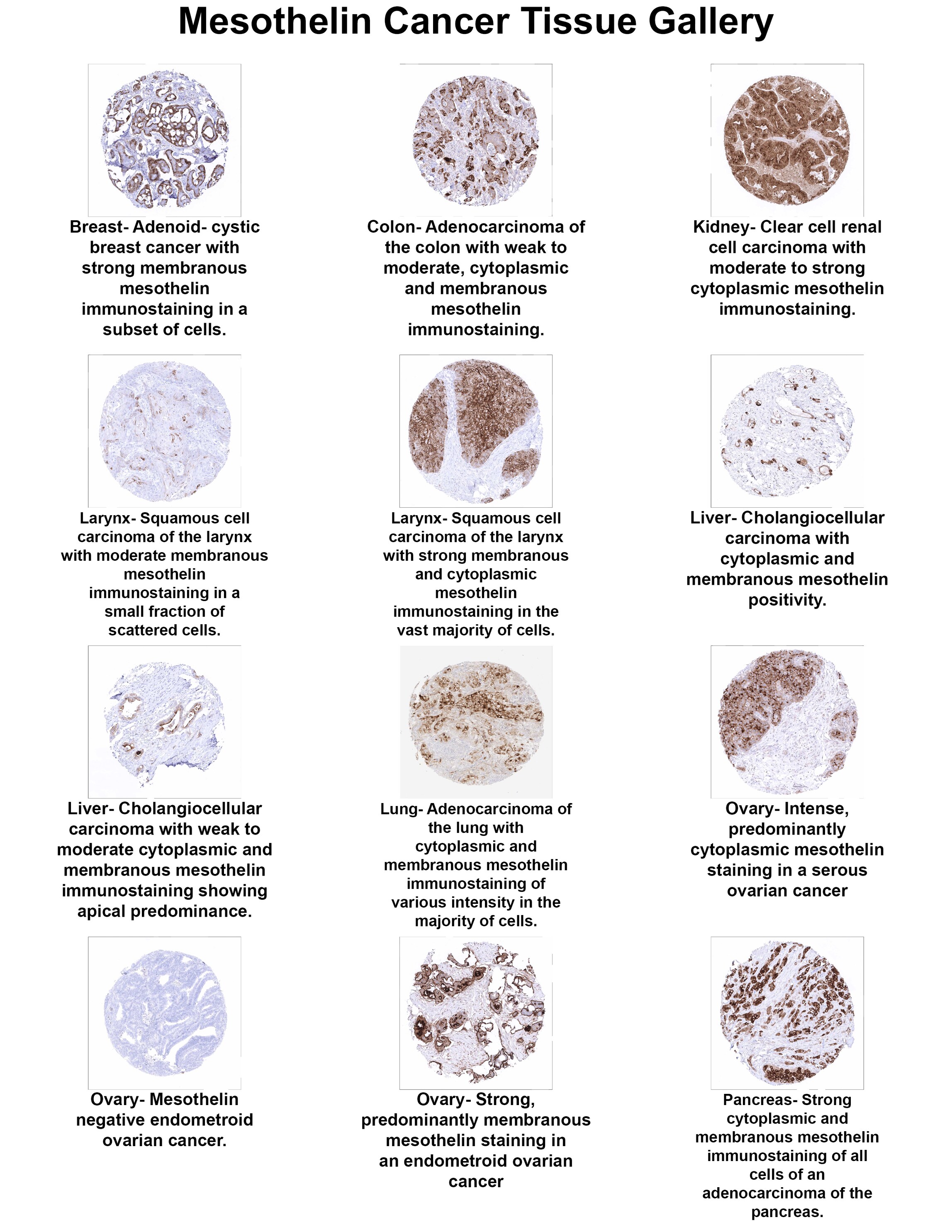 Mesothelin Antibody (MSVA-235M) Mesothelin Antibody (MSVA-235M) Mesothelin Cancer Tissue Gallery