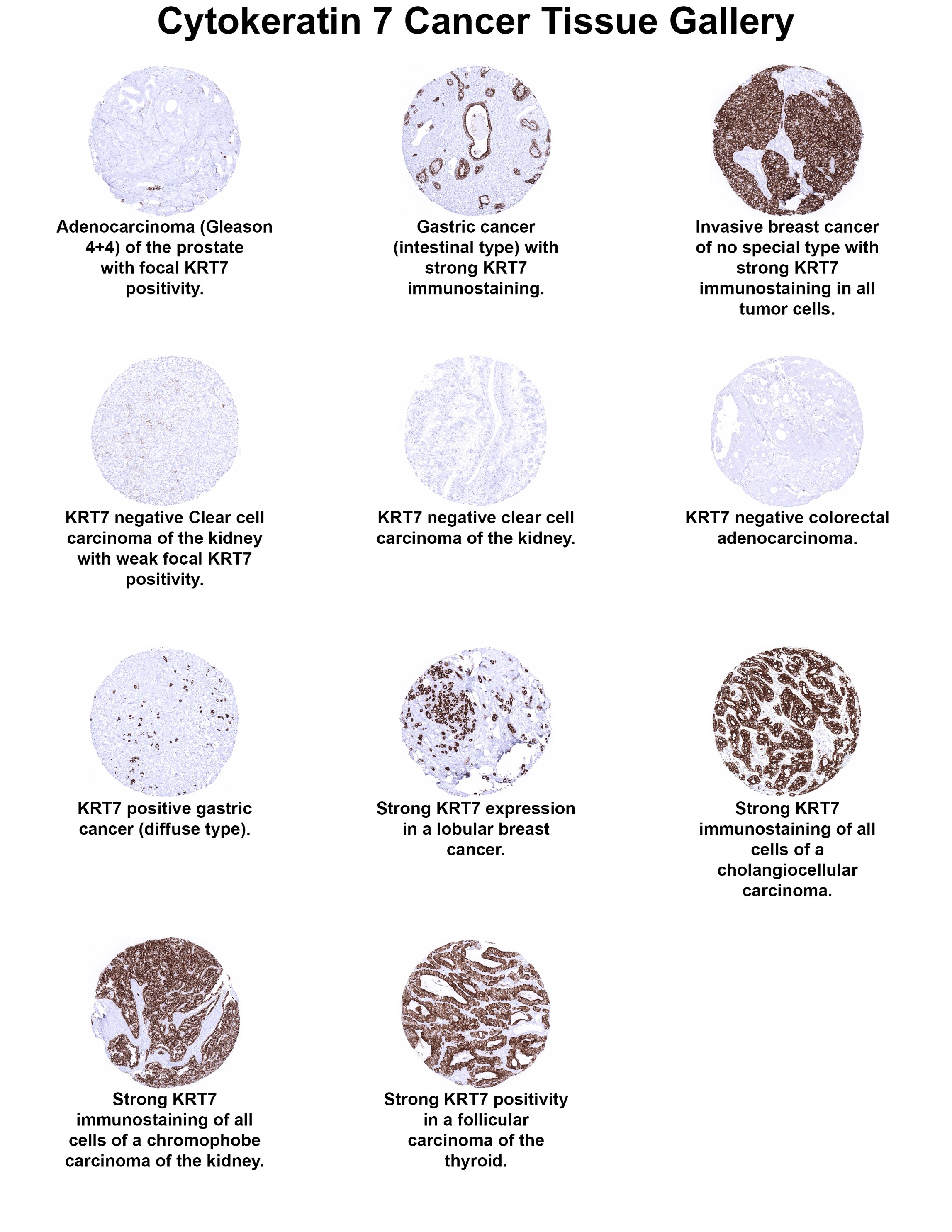 Cytokeratin 7 Antibody (MSVA-607R) Cytokeratin 7 Antibody (MSVA-607R) Cytokeratin 7 Cancer Tissue Gallery