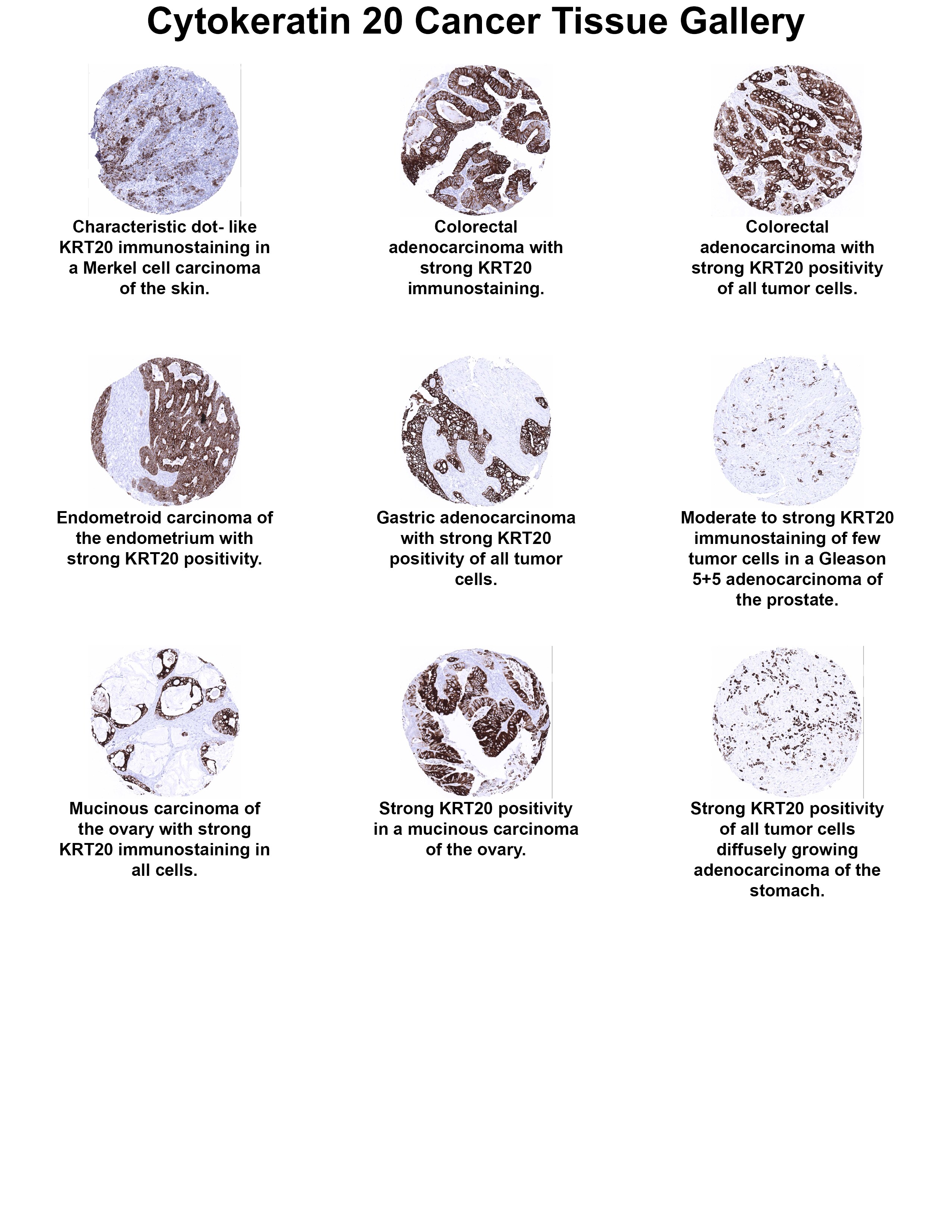 Cytokeratin 20 Antibody (MSVA-620R) Cytokeratin 20 Antibody (MSVA-620R) Cytokeratin 20 Cancer Tissue Gallery