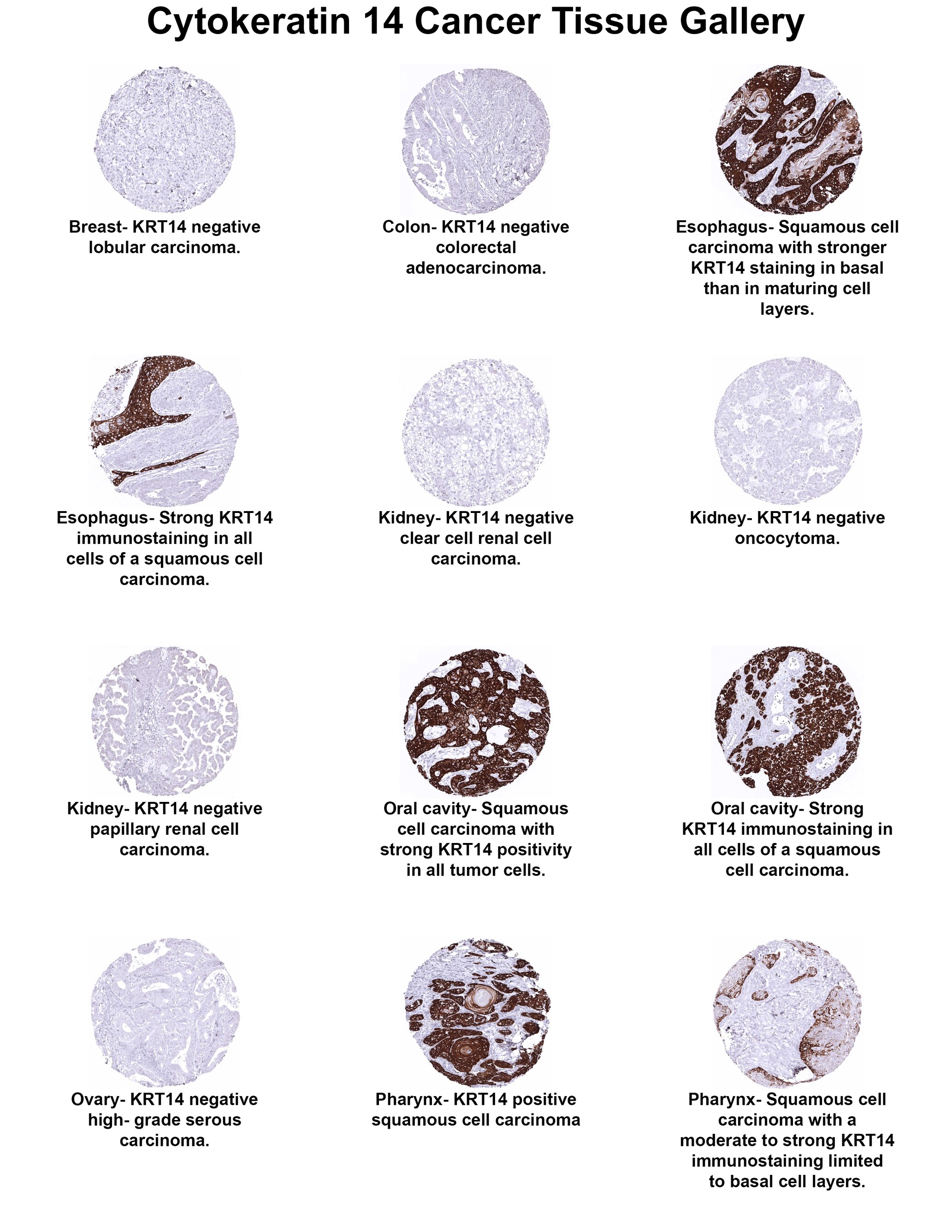 Cytokeratin 14 Antibody (MSVA-614R) Cytokeratin 14 Antibody (MSVA-614R) Cytokeratin 14 Cancer Tissue Gallery