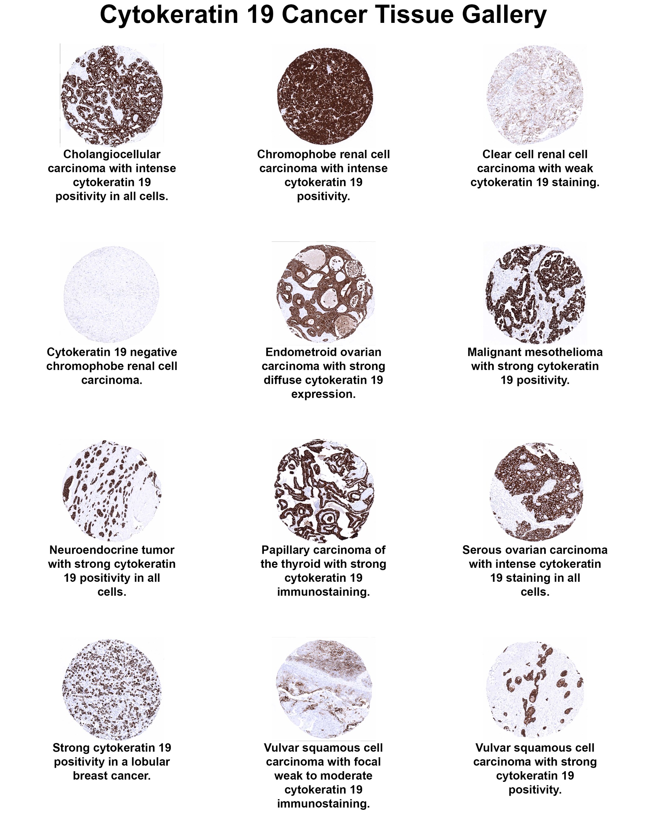 Cytokeratin 19 Antibody (MSVA-119M) Cytokeratin 19 Antibody (MSVA-119M) Cytokeratin 19 Cancer Tissue Gallery