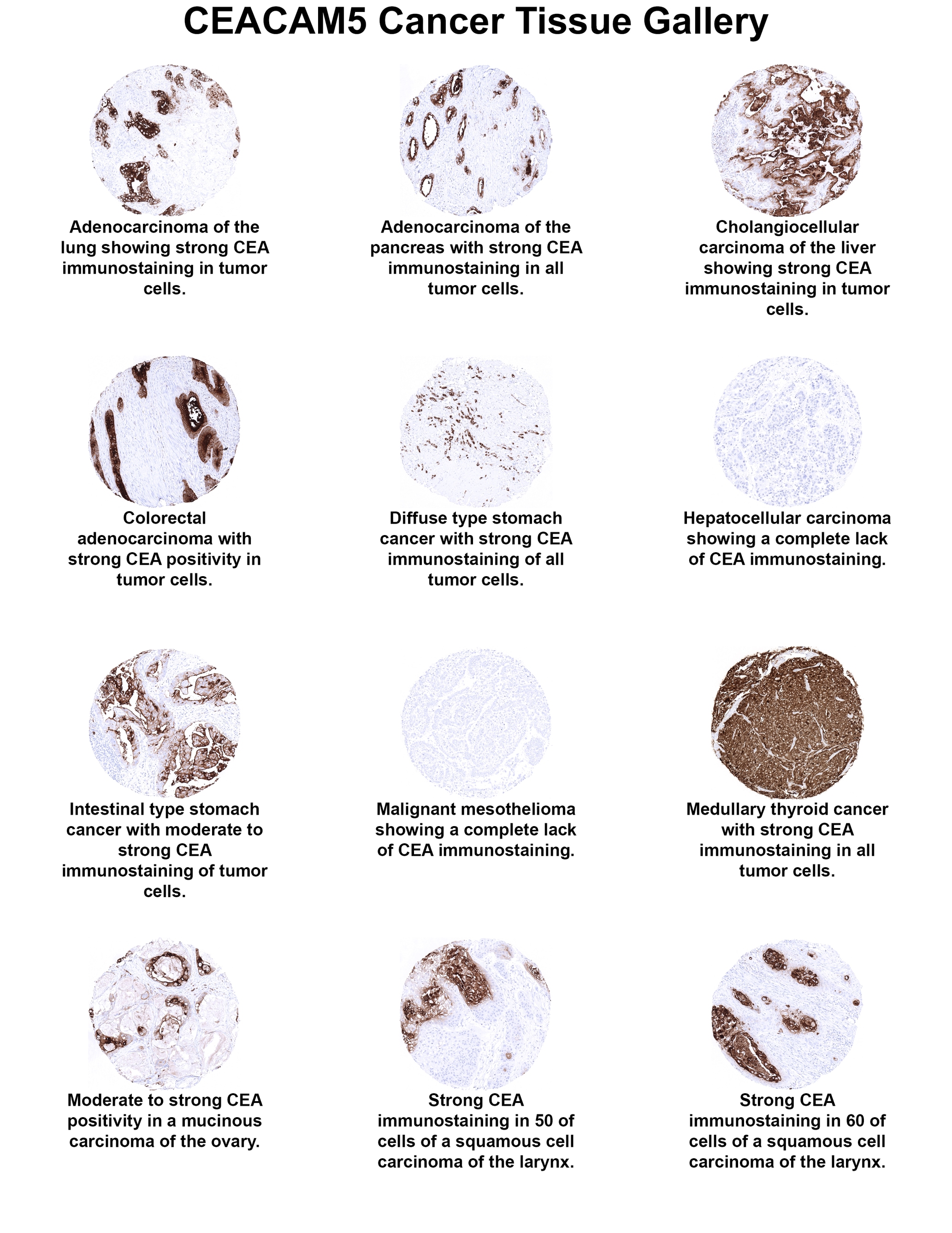 CEA Antibody (MSVA-465R) CEA Antibody (MSVA-465R) CEA Cancer Tissue Gallery