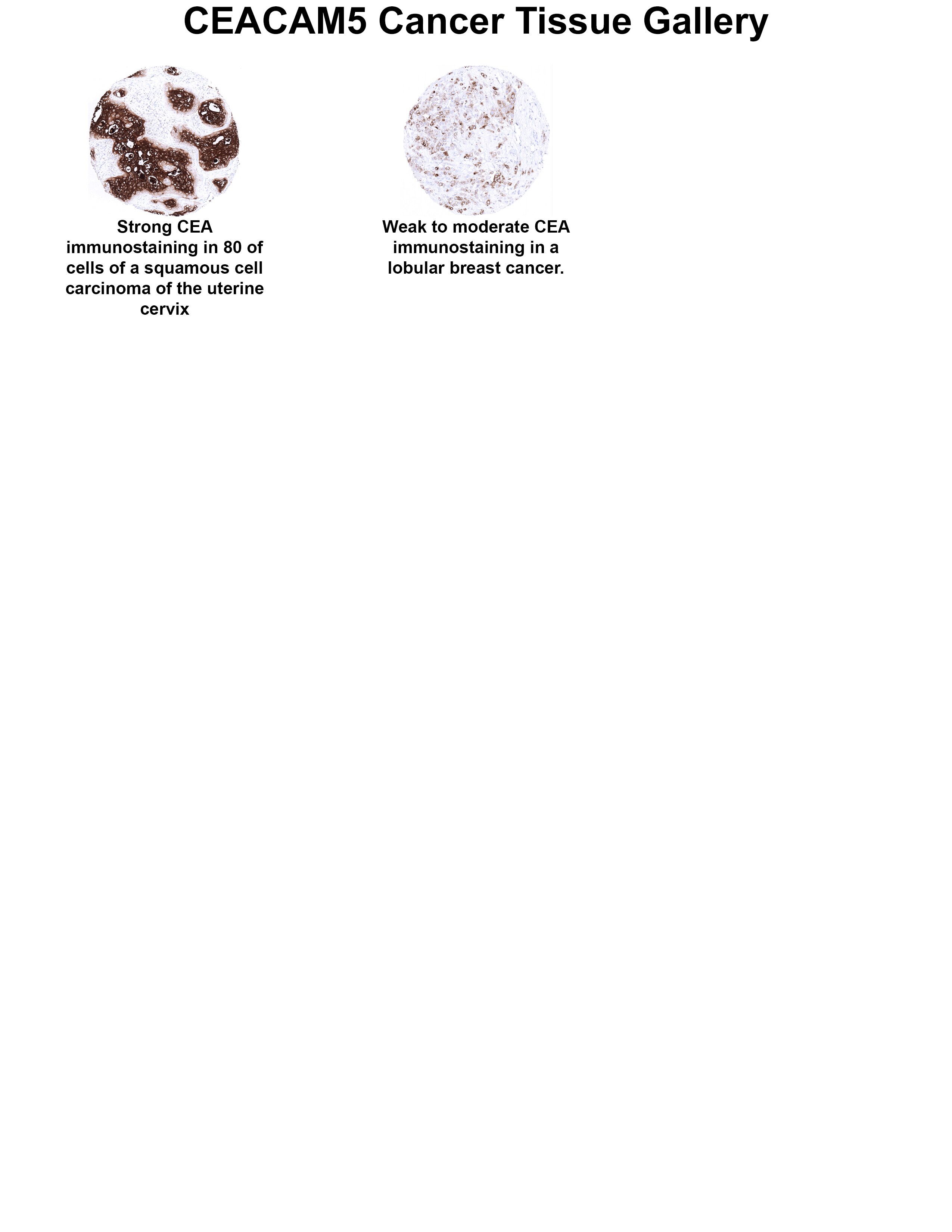 CEA Antibody (MSVA-465R) CEA Antibody (MSVA-465R) CEA Cancer Tissue Gallery