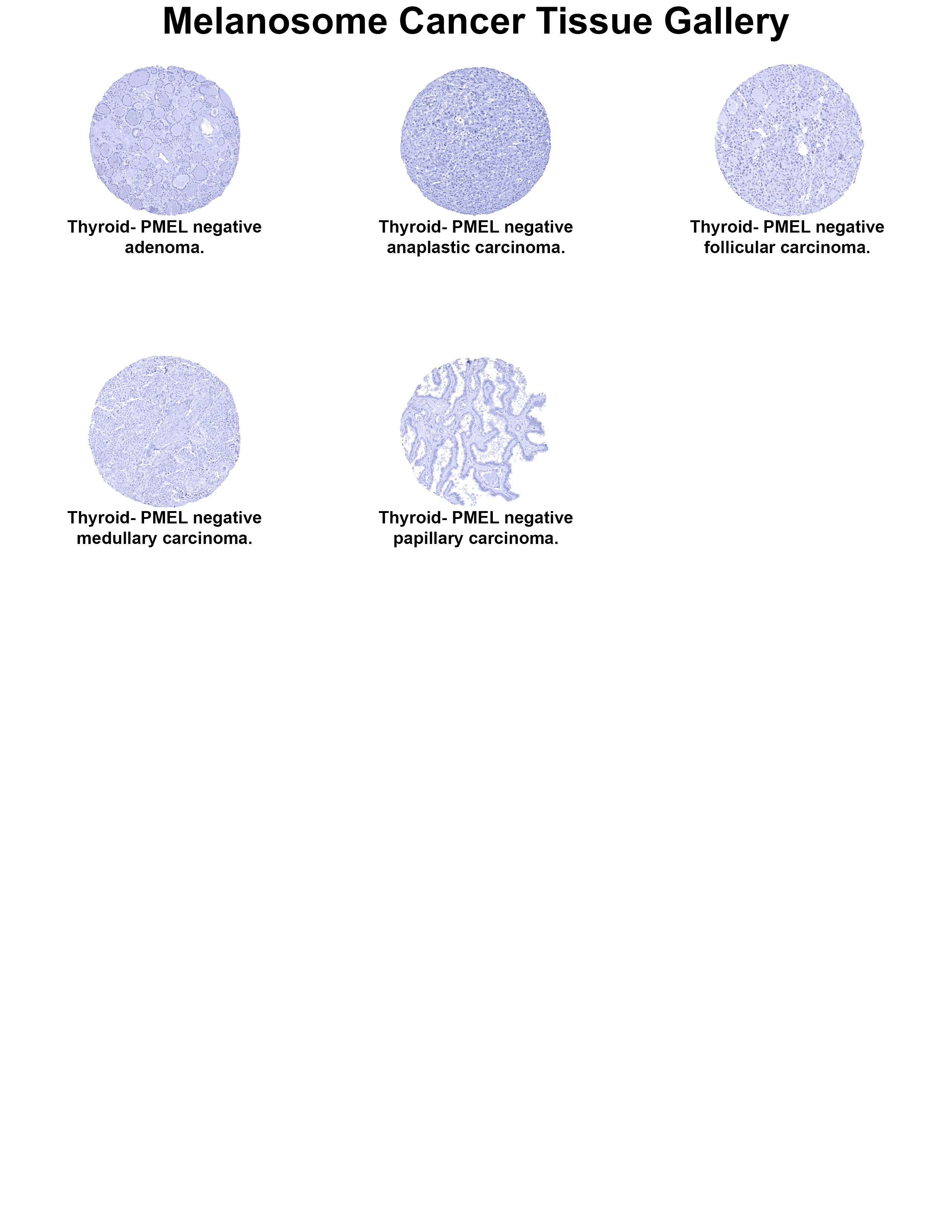 PMEL17/SILV Antibody (MSVA-617R) PMEL17/SILV Antibody (MSVA-617R) PMEL17/SILV Cancer Tissue Gallery