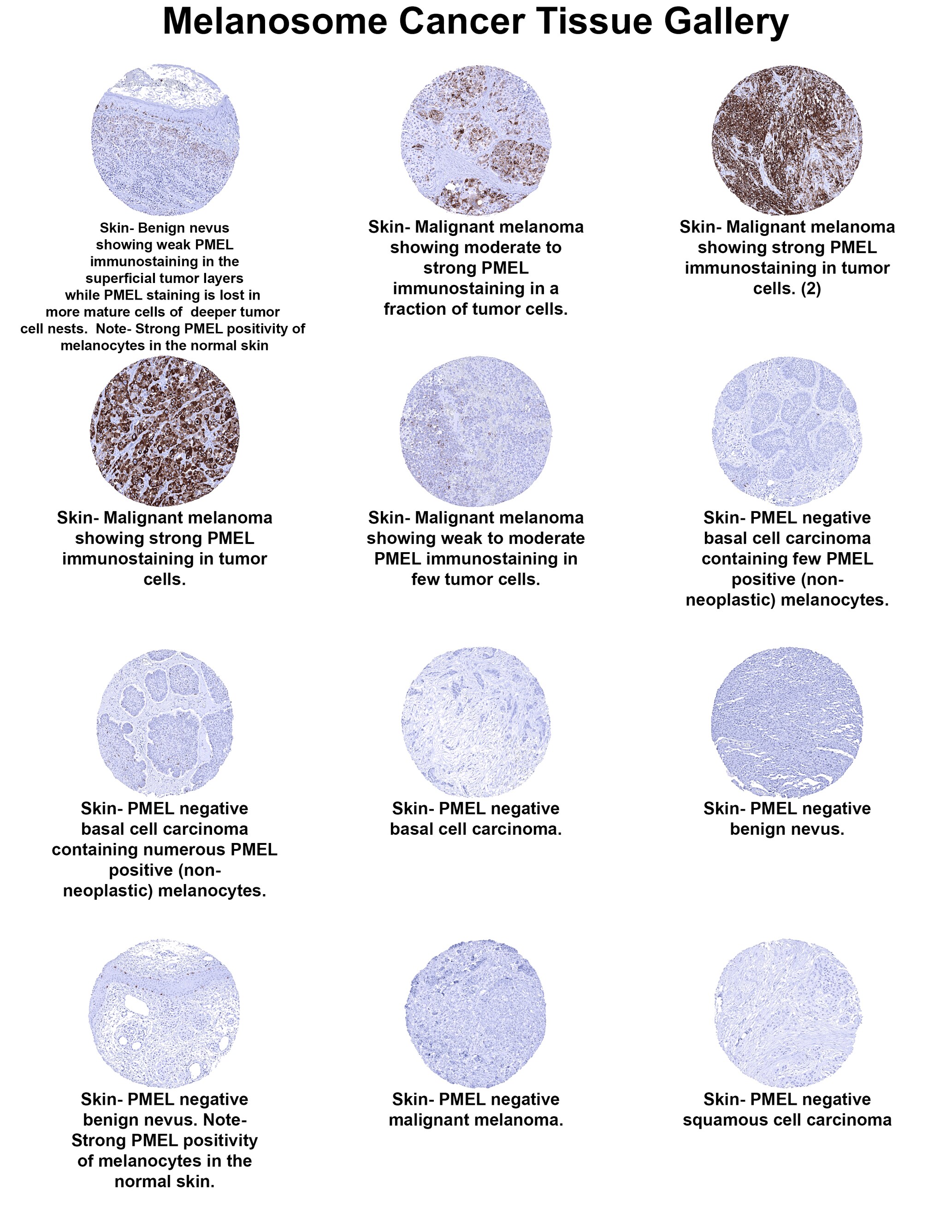 PMEL17/SILV Antibody (MSVA-617R) PMEL17/SILV Antibody (MSVA-617R) PMEL17/SILV Cancer Tissue Gallery