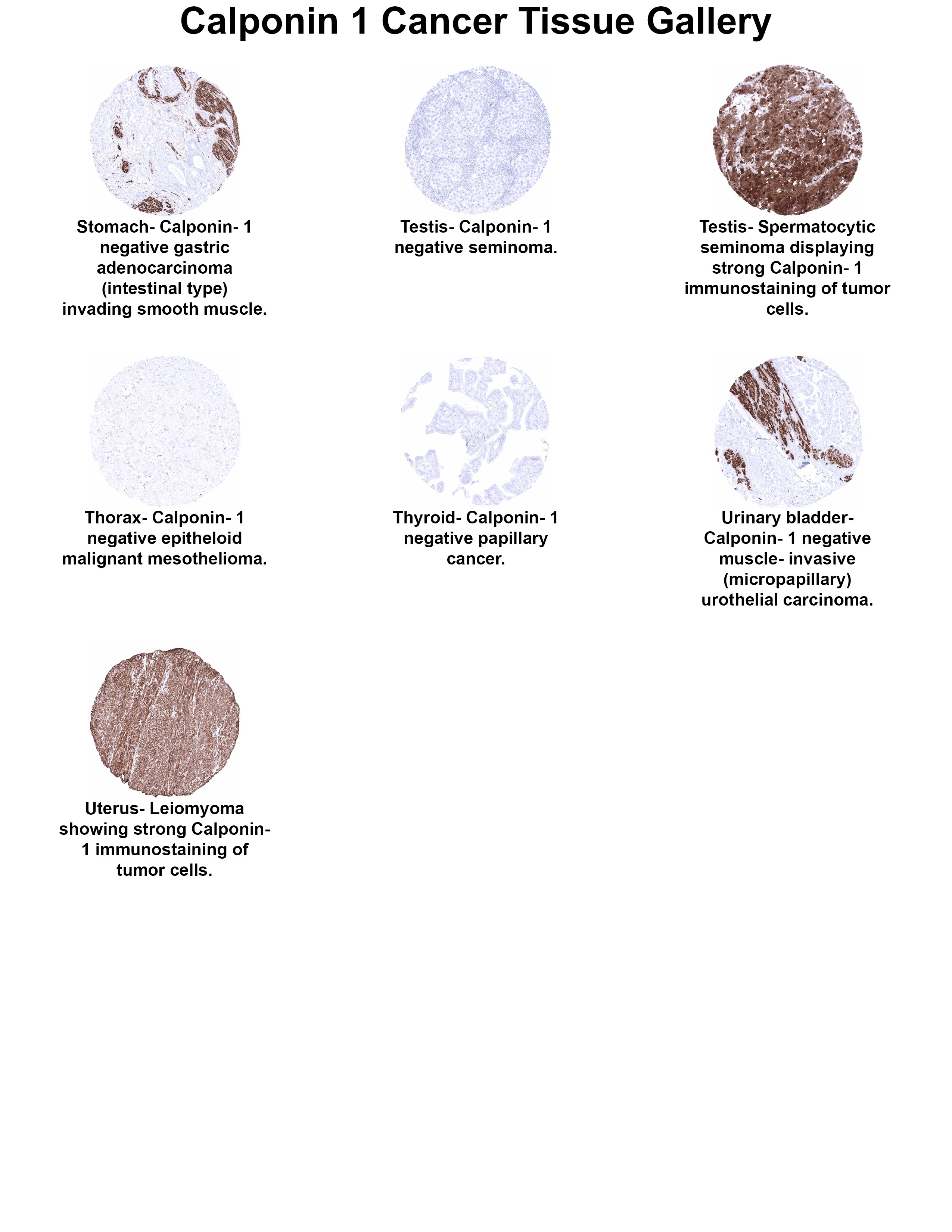 Calponin 1 Antibody (MSVA-455R) Calponin 1 Antibody (MSVA-455R) Calponin 1 Cancer Tissue Gallery