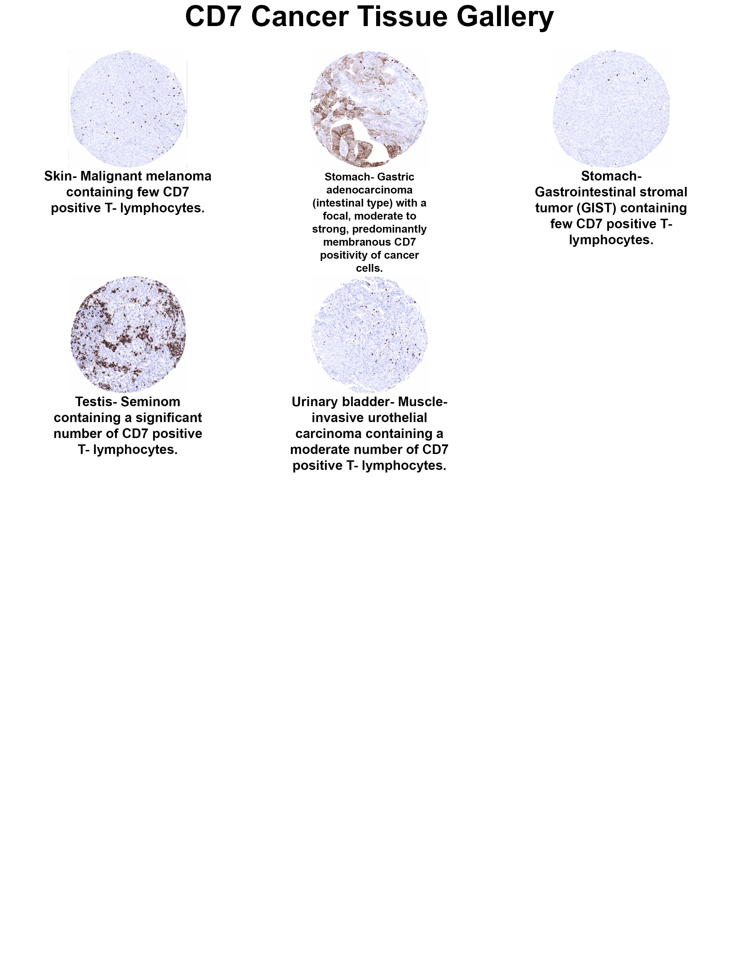 CD7 Antibody (MSVA-007R) CD7 Antibody (MSVA-007R) CD7 Cancer Tissue Gallery