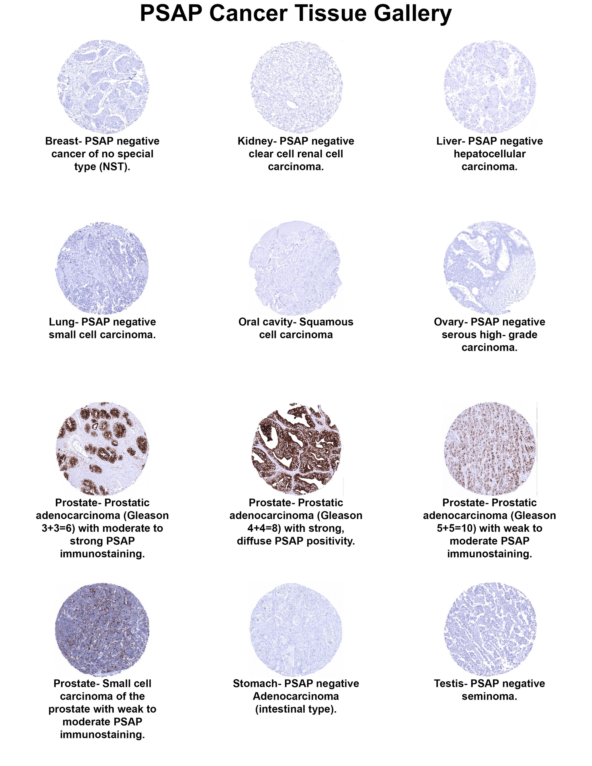 PSAP Antibody (MSVA-452M) PSAP Antibody (MSVA-452M) PSAP Cancer Tissue Gallery