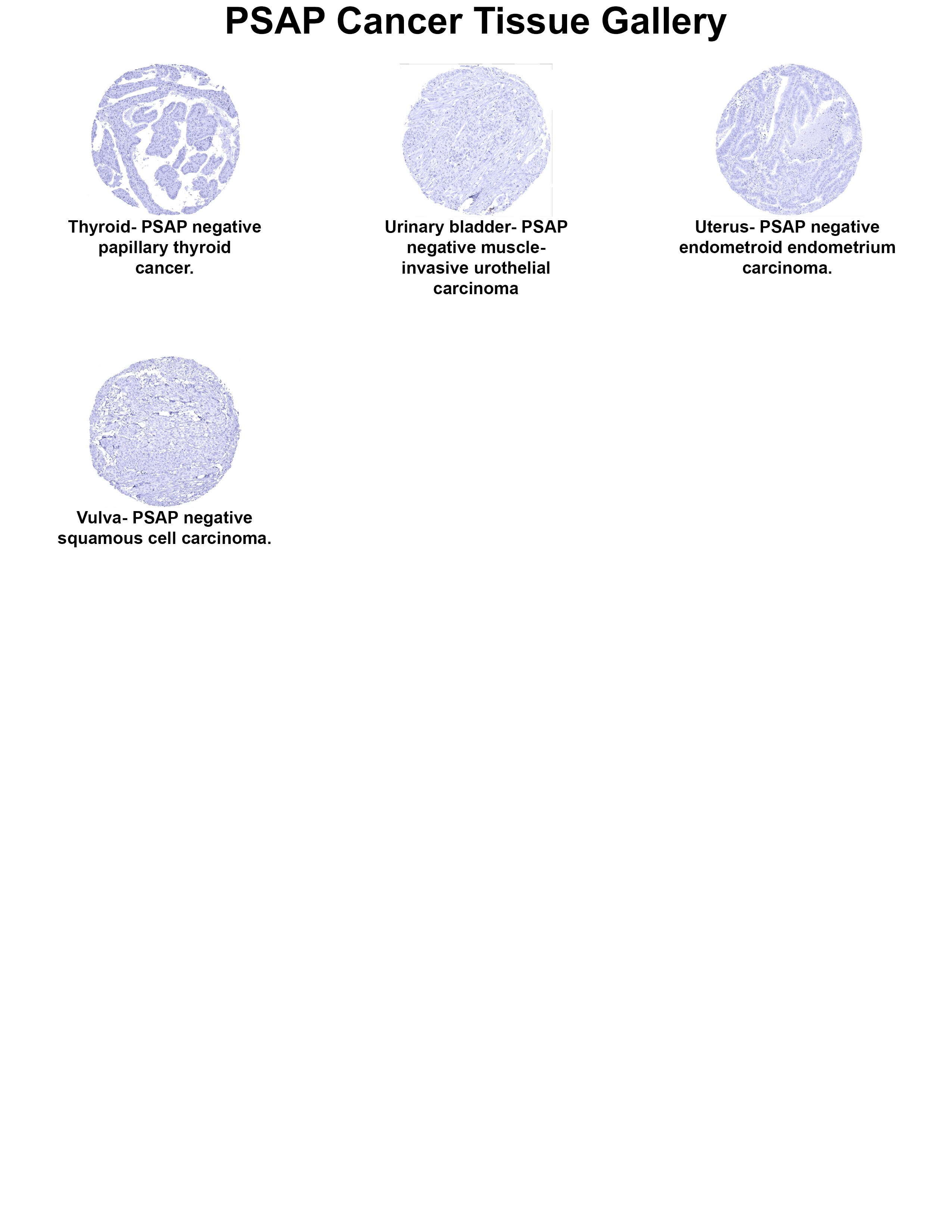 PSAP Antibody (MSVA-452M) PSAP Antibody (MSVA-452M) PSAP Cancer Tissue Gallery