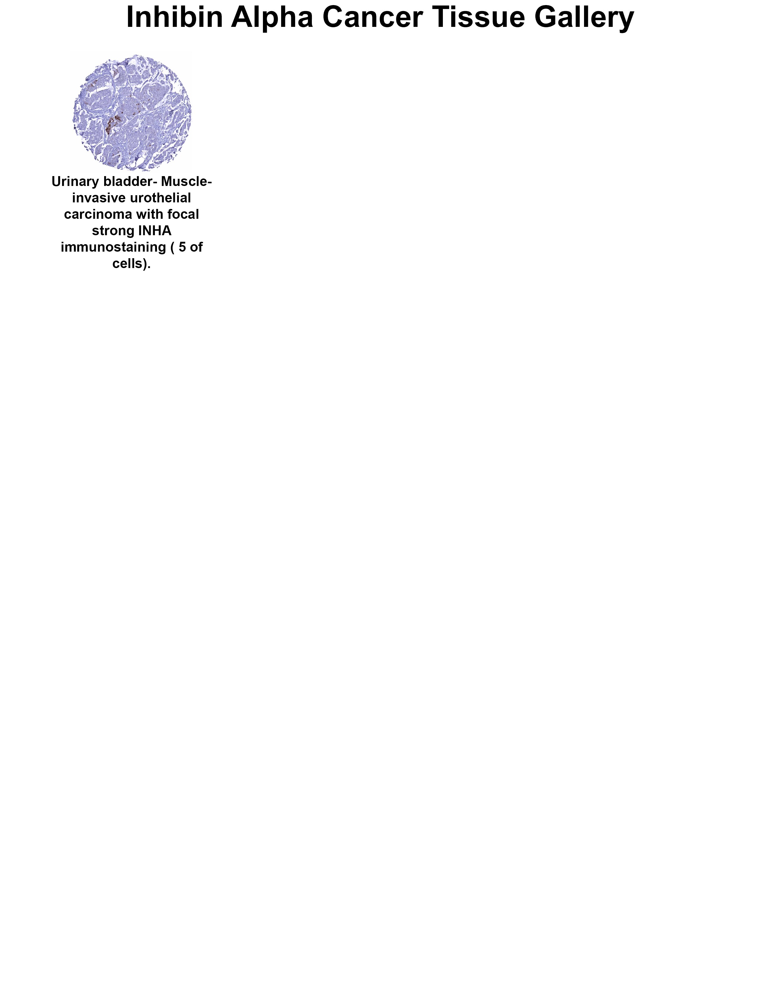 Inhibin alpha Antibody (MSVA-561R) Inhibin alpha Antibody (MSVA-561R) Inhibin alpha Cancer Tissue Gallery
