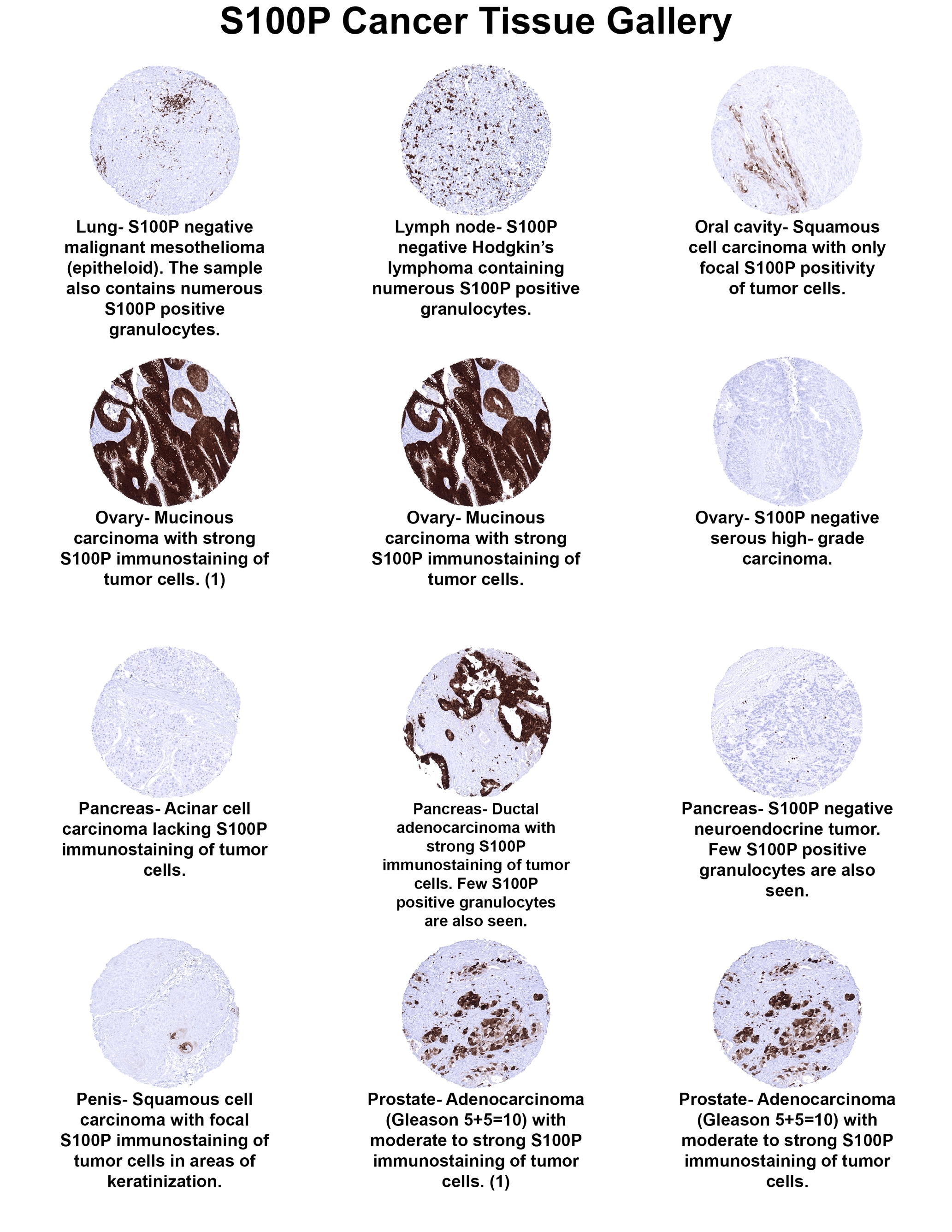 S100P Antibody (MSVA-480R) S100P Antibody (MSVA-480R) S100P Cancer Tissue Gallery