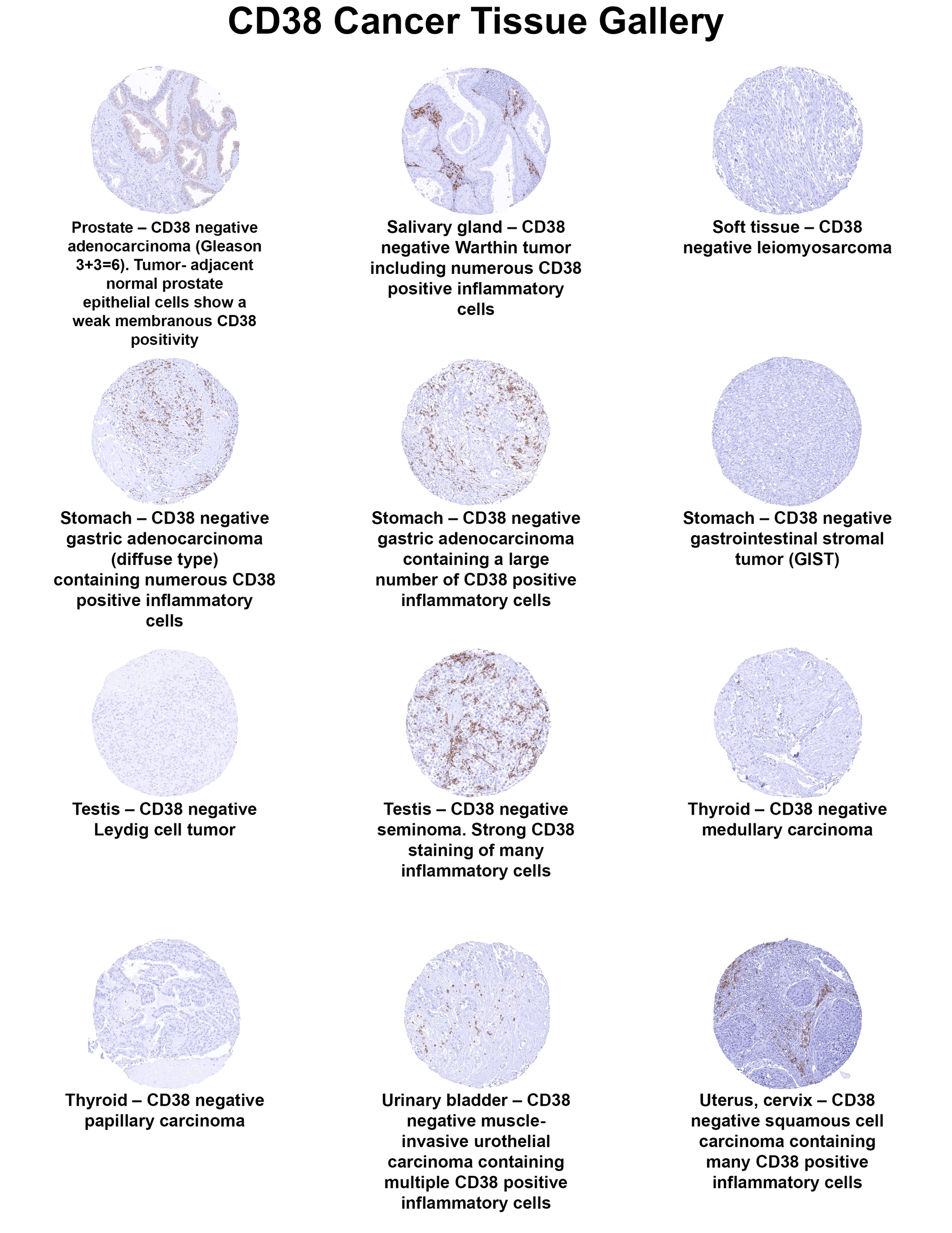 CD38 Antibody (MSVA-038R) CD38 Antibody (MSVA-038R) CD38 Cancer Tissue Gallery