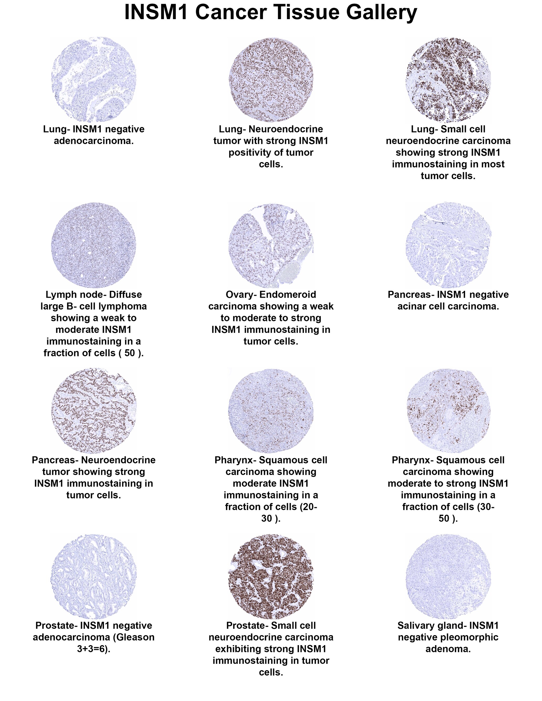 INSM1 Antibody (MSVA-456R) INSM1 Antibody (MSVA-456R) INSM1 Cancer Tissue Gallery