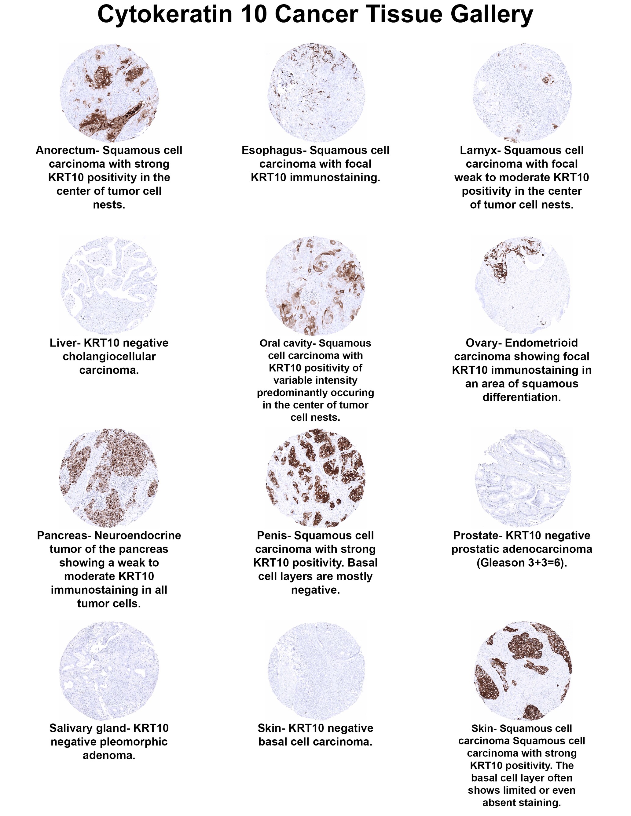 Cytokeratin 10 Antibody (MSVA-610M) Cytokeratin 10 Antibody (MSVA-610M) Cytokeratin 10 Cancer Tissue Gallery